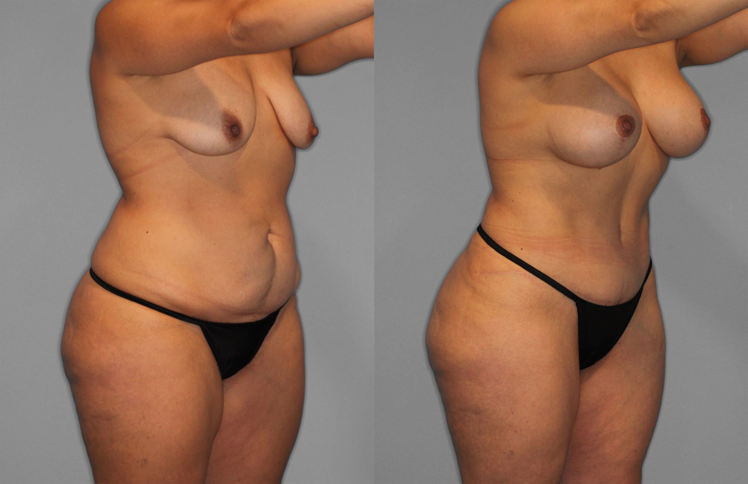 Tummy Tuck Before and After photo by Dr. Abigail Rodriguez in Houston, TX