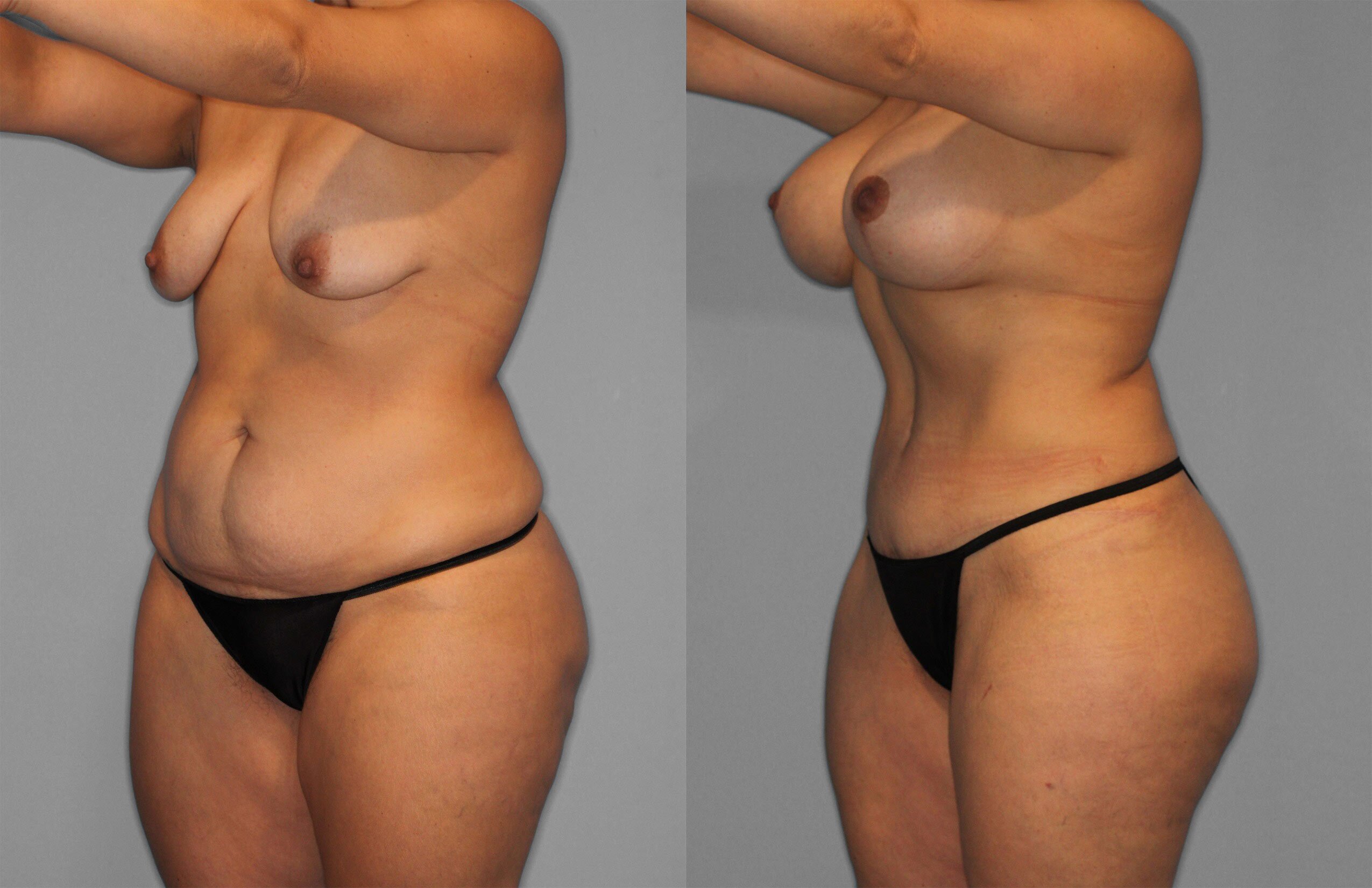 Tummy Tuck Before and After photo by Dr. Abigail Rodriguez in Houston, TX