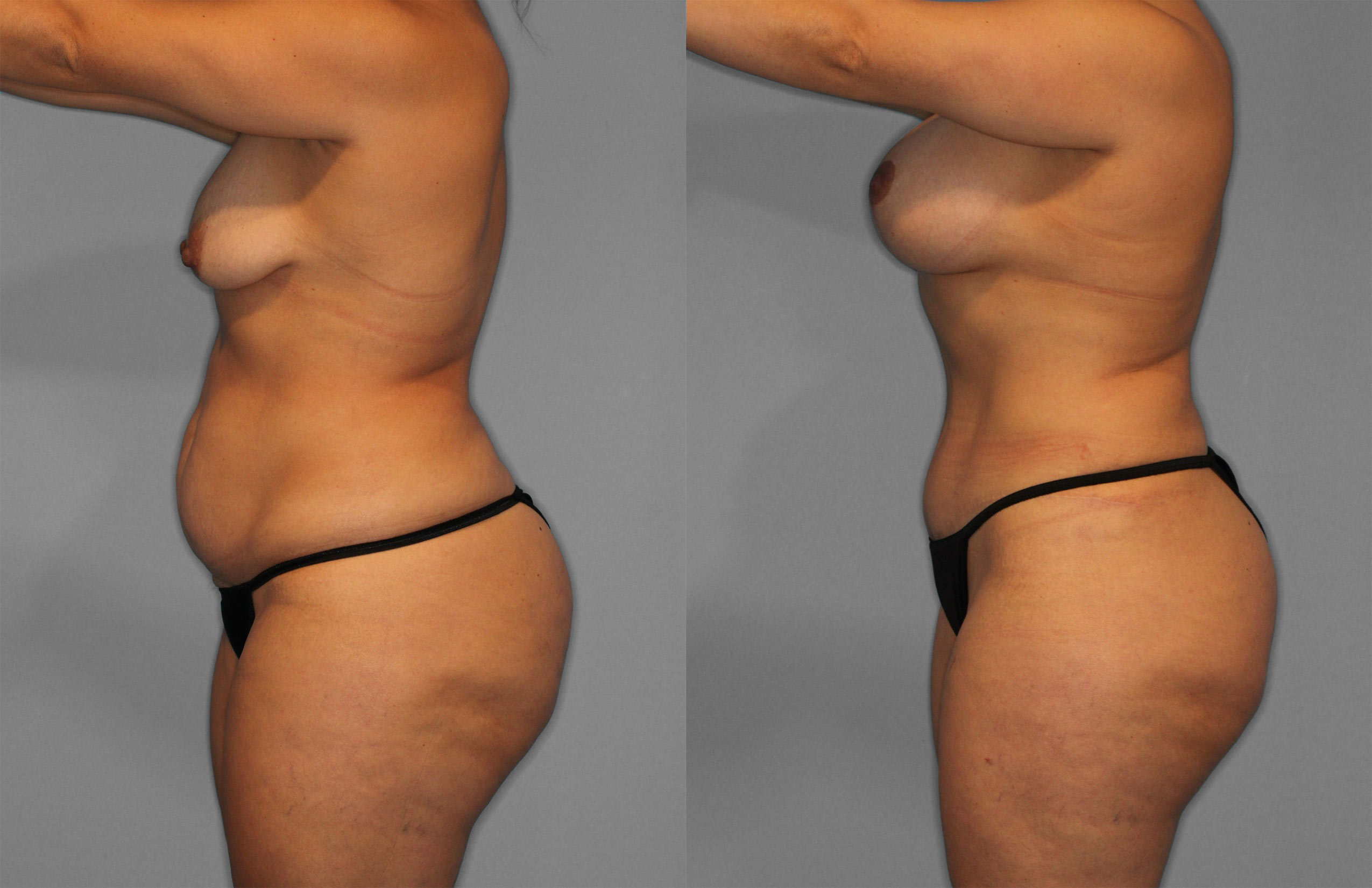Tummy Tuck Before and After photo by Dr. Abigail Rodriguez in Houston, TX