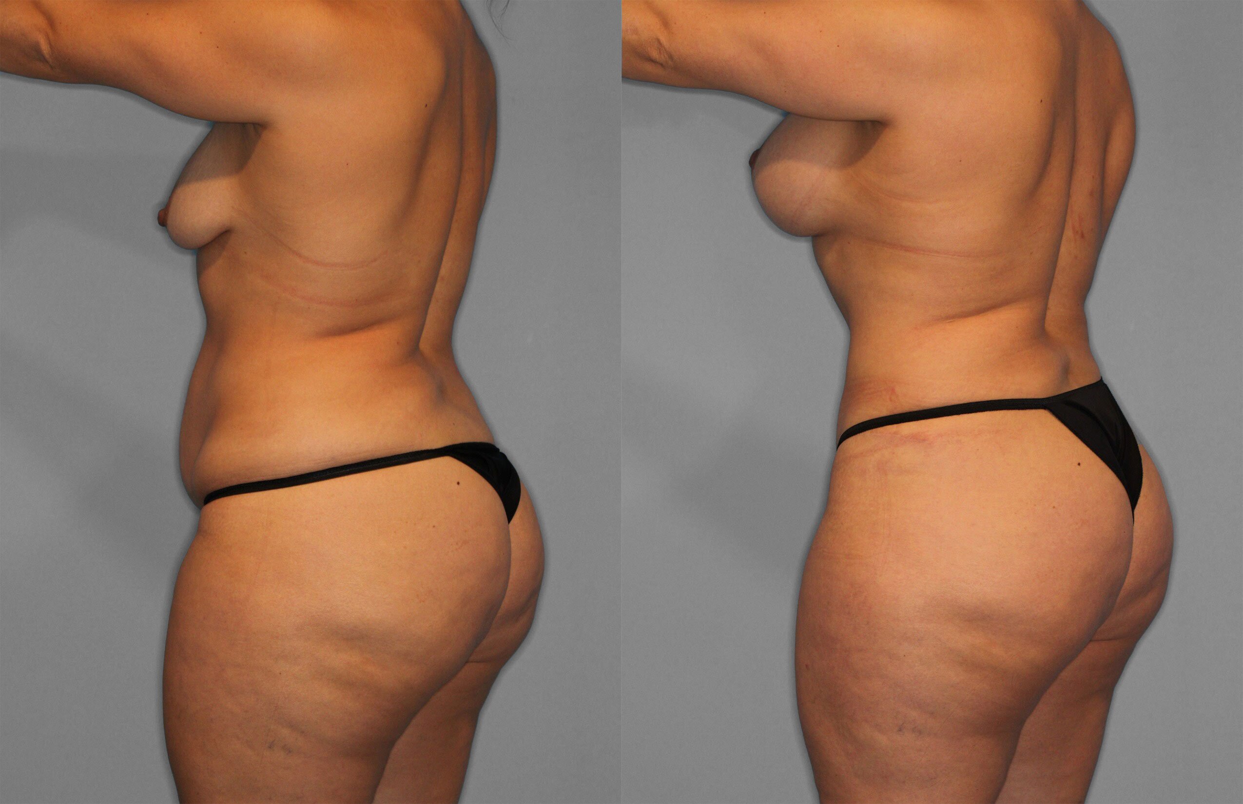 Tummy Tuck Before and After photo by Dr. Abigail Rodriguez in Houston, TX