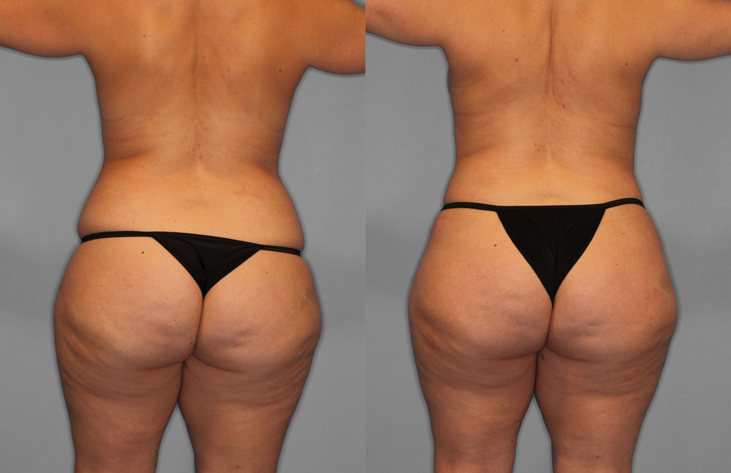 Tummy Tuck Before and After photo by Dr. Abigail Rodriguez in Houston, TX