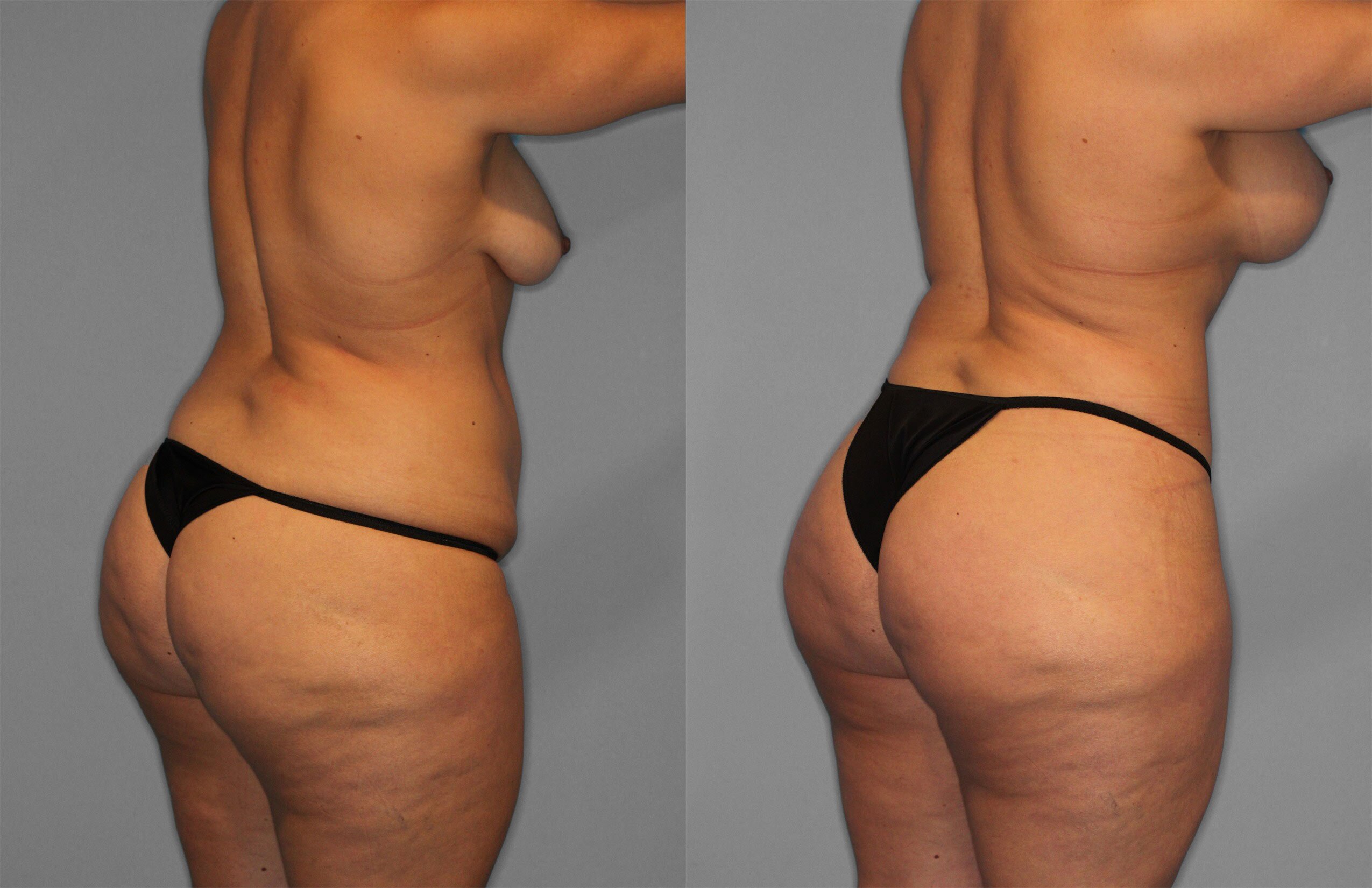 Tummy Tuck Before and After photo by Dr. Abigail Rodriguez in Houston, TX