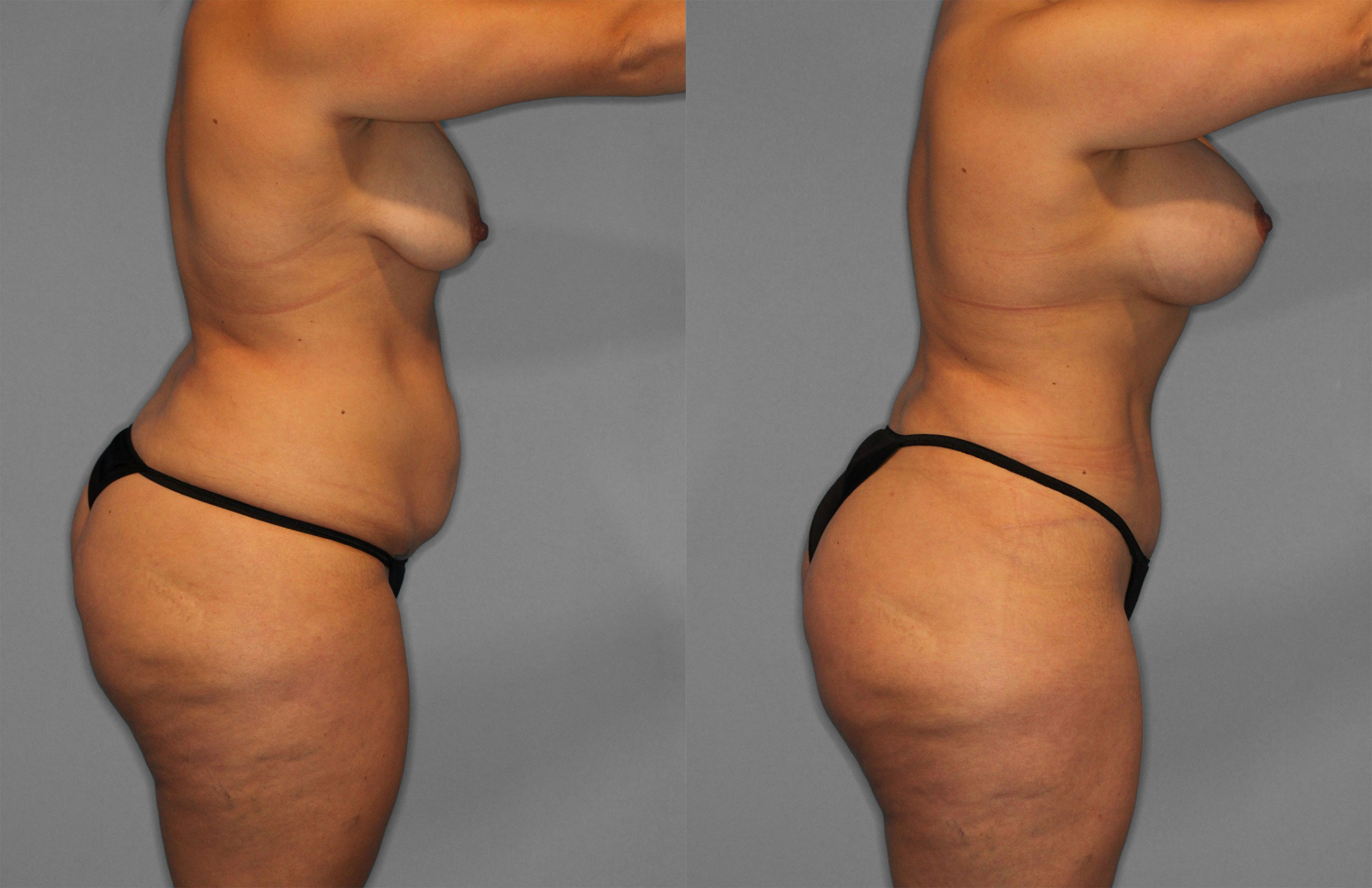 Tummy Tuck Before and After photo by Dr. Abigail Rodriguez in Houston, TX