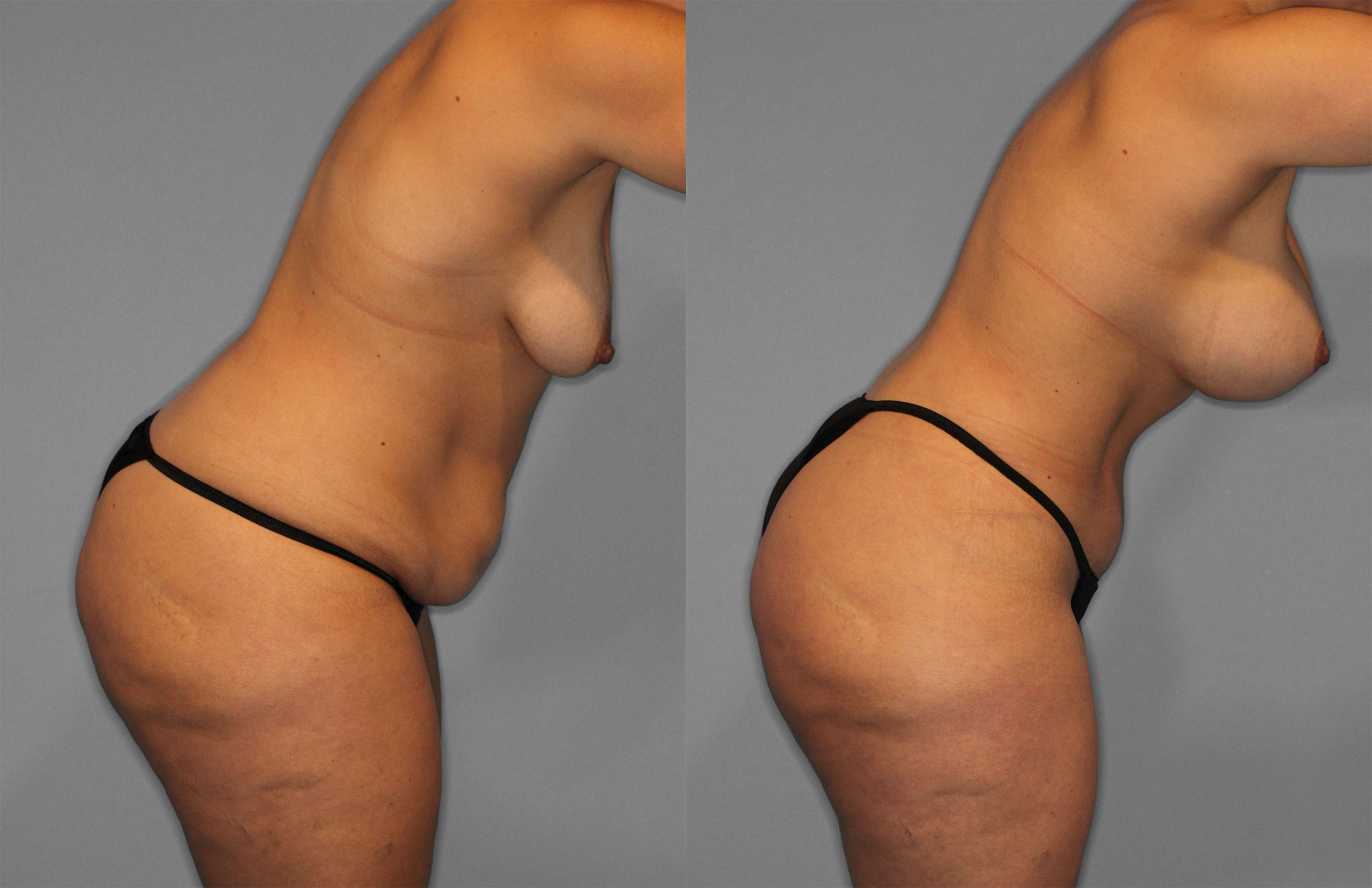 Tummy Tuck Before and After photo by Dr. Abigail Rodriguez in Houston, TX