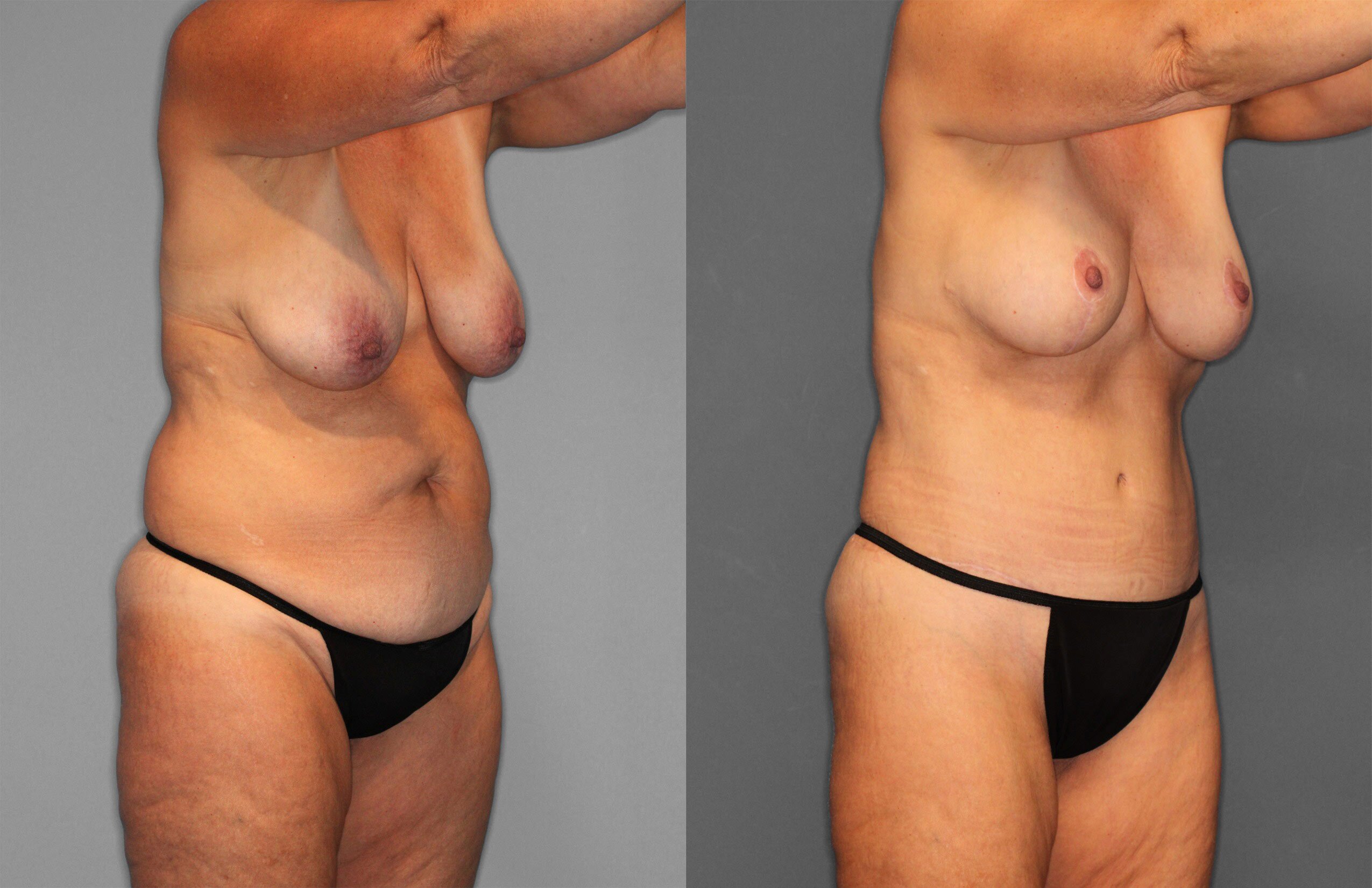 Tummy Tuck Before and After photo by Dr. Abigail Rodriguez in Houston, TX