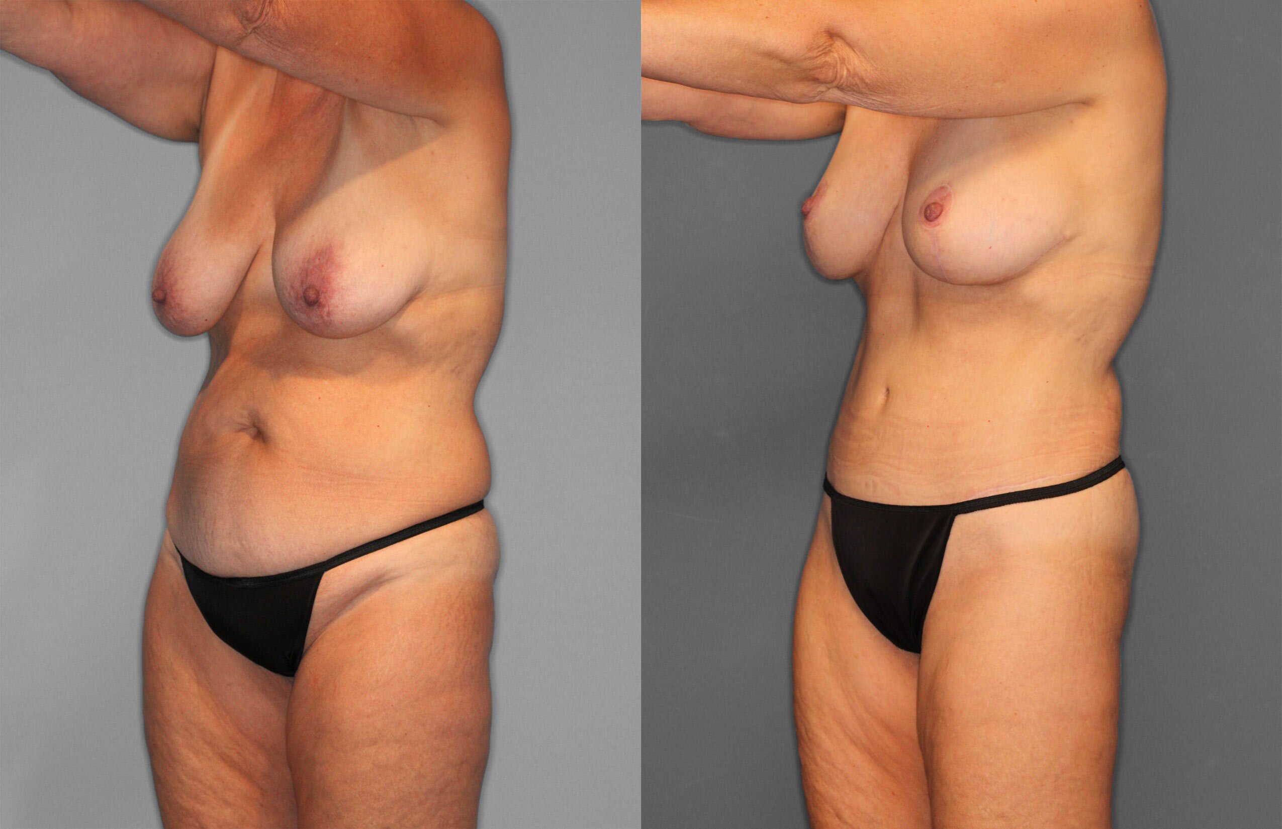 Tummy Tuck Before and After photo by Dr. Abigail Rodriguez in Houston, TX