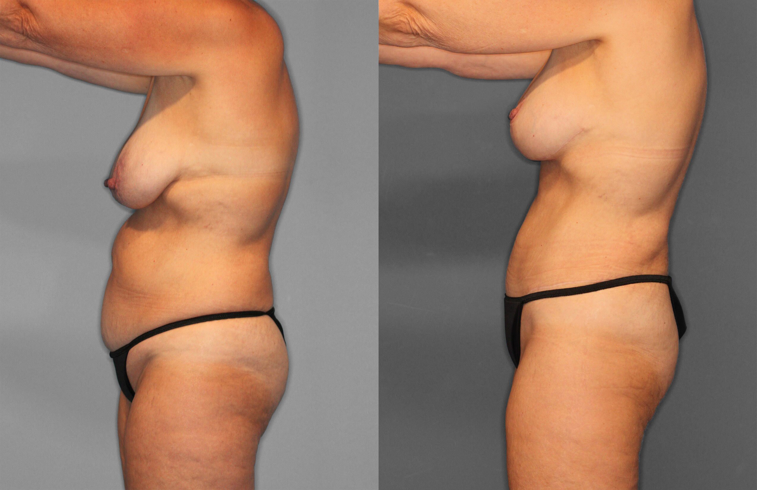 Tummy Tuck Before and After photo by Dr. Abigail Rodriguez in Houston, TX