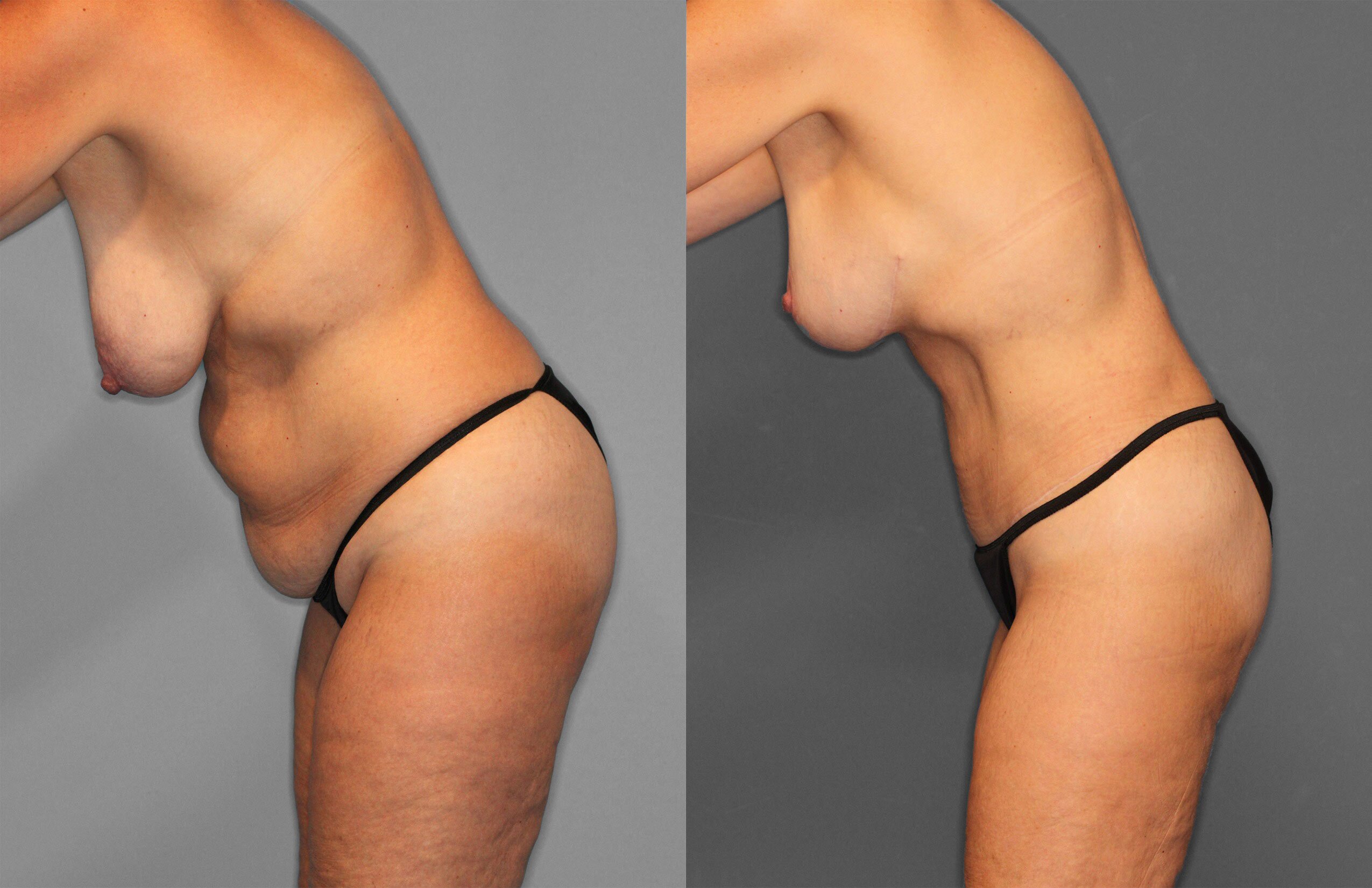 Tummy Tuck Before and After photo by Dr. Abigail Rodriguez in Houston, TX