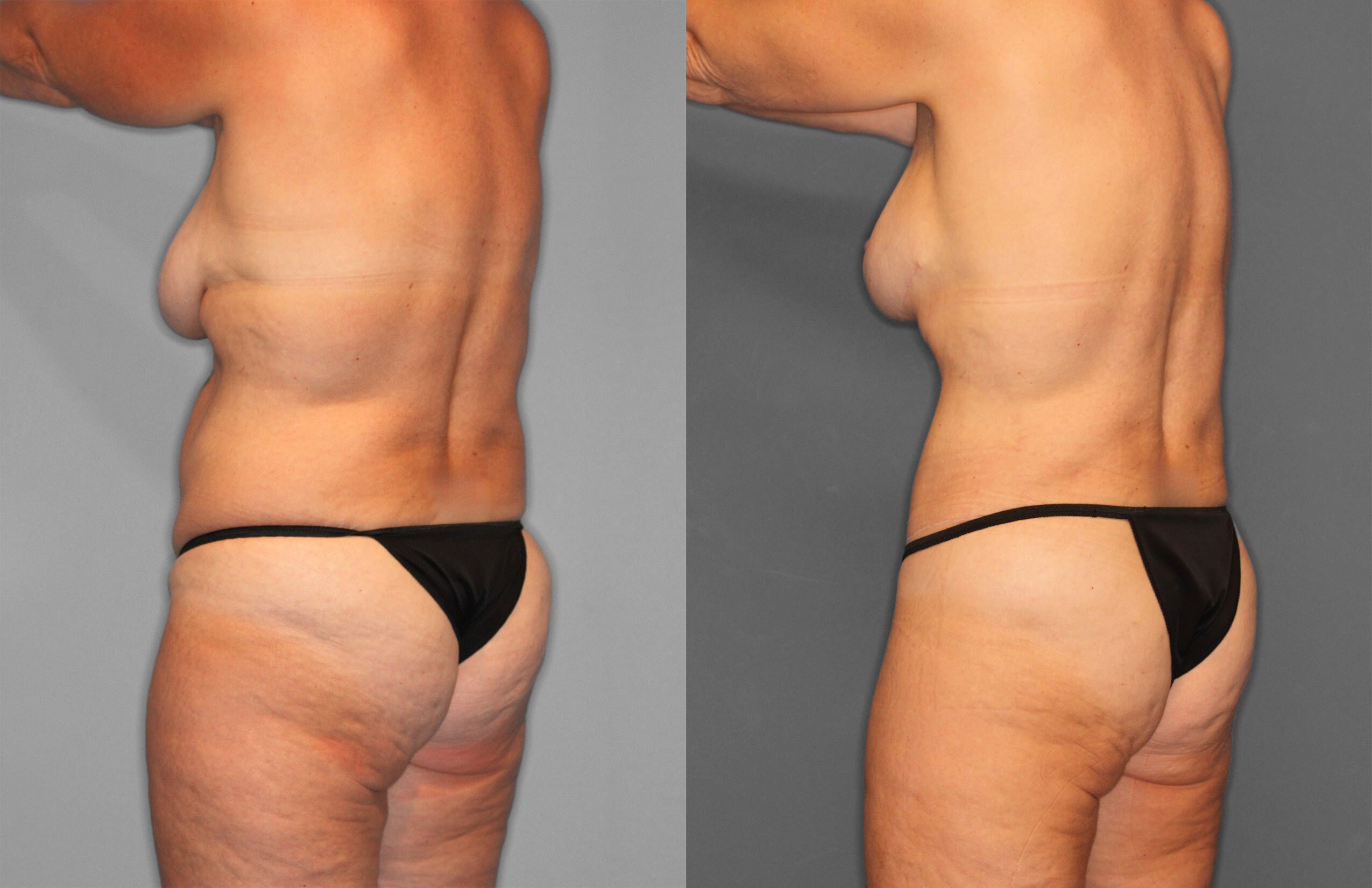 Tummy Tuck Before and After photo by Dr. Abigail Rodriguez in Houston, TX