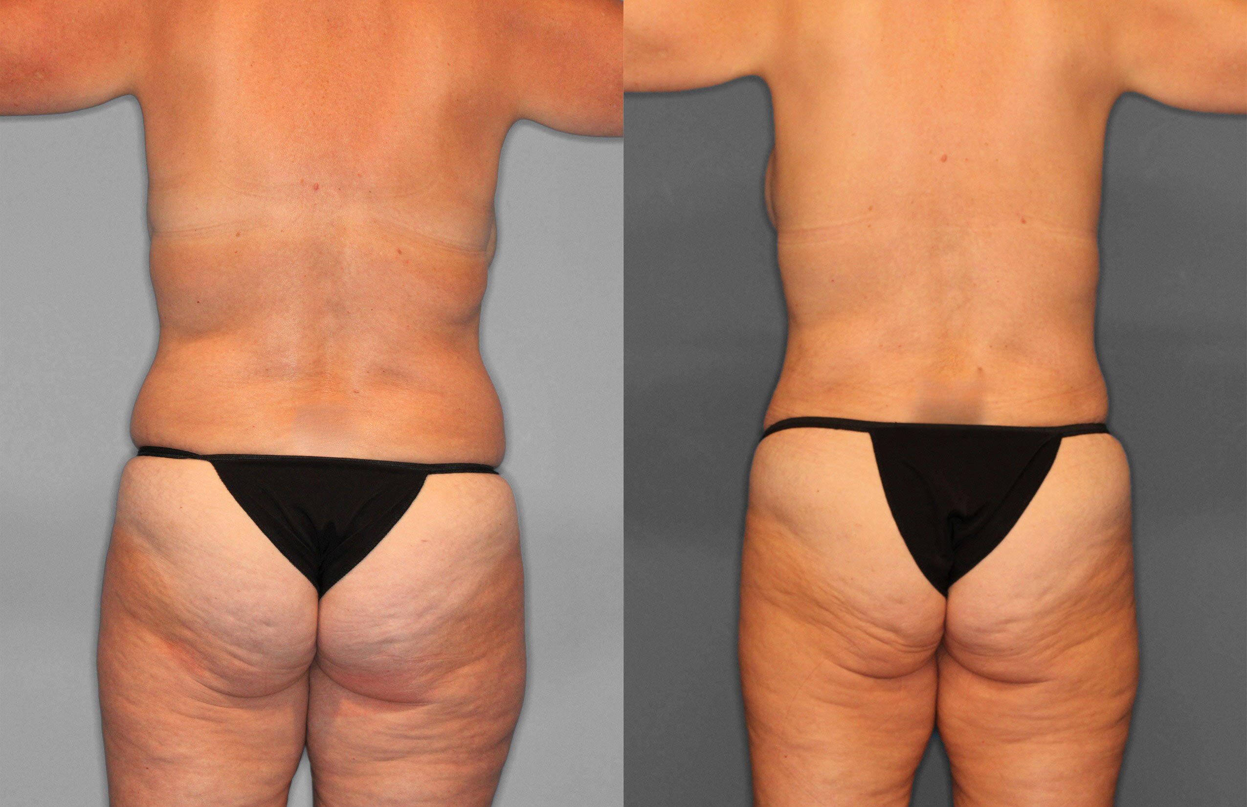 Tummy Tuck Before and After photo by Dr. Abigail Rodriguez in Houston, TX