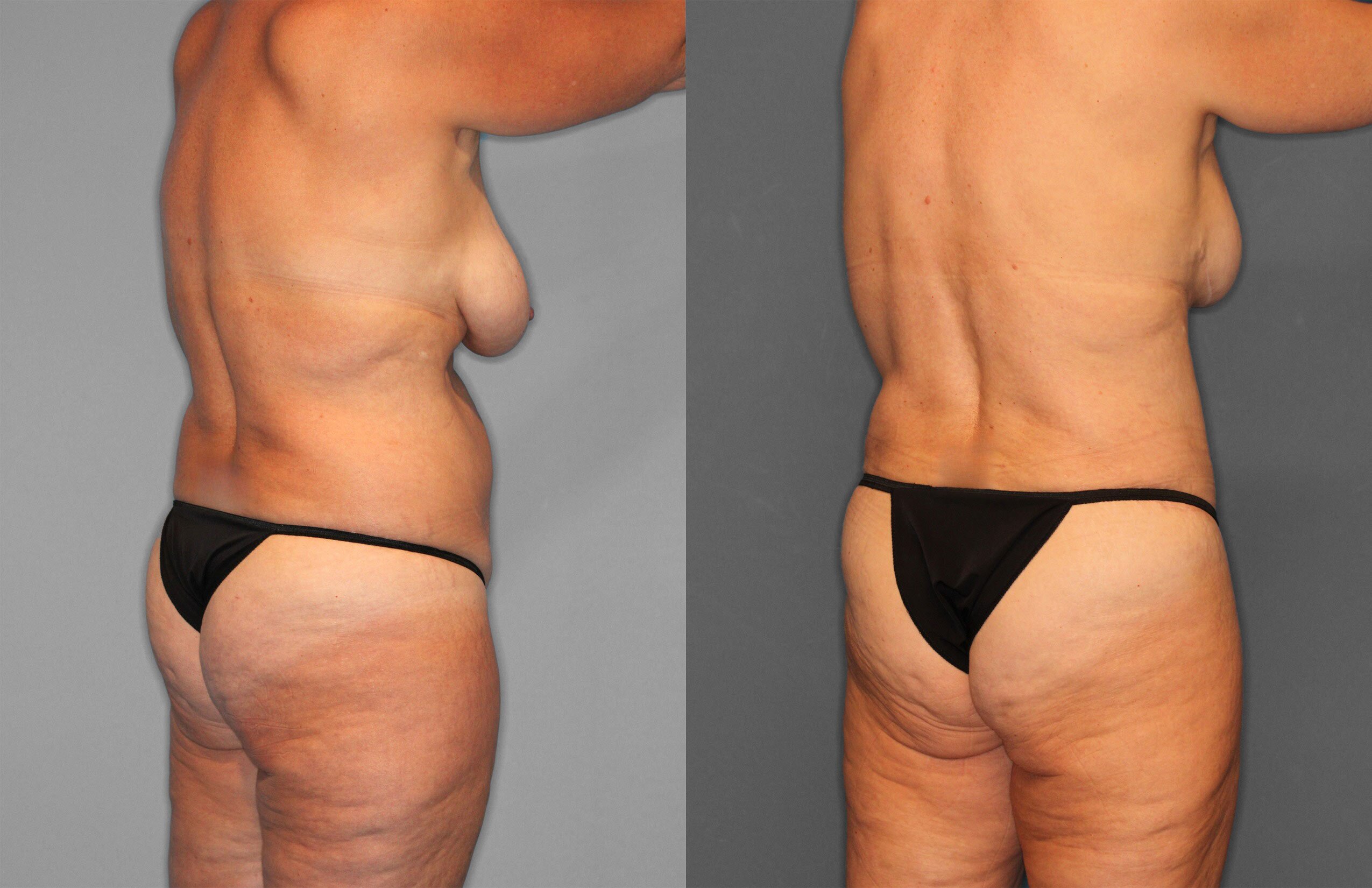 Tummy Tuck Before and After photo by Dr. Abigail Rodriguez in Houston, TX