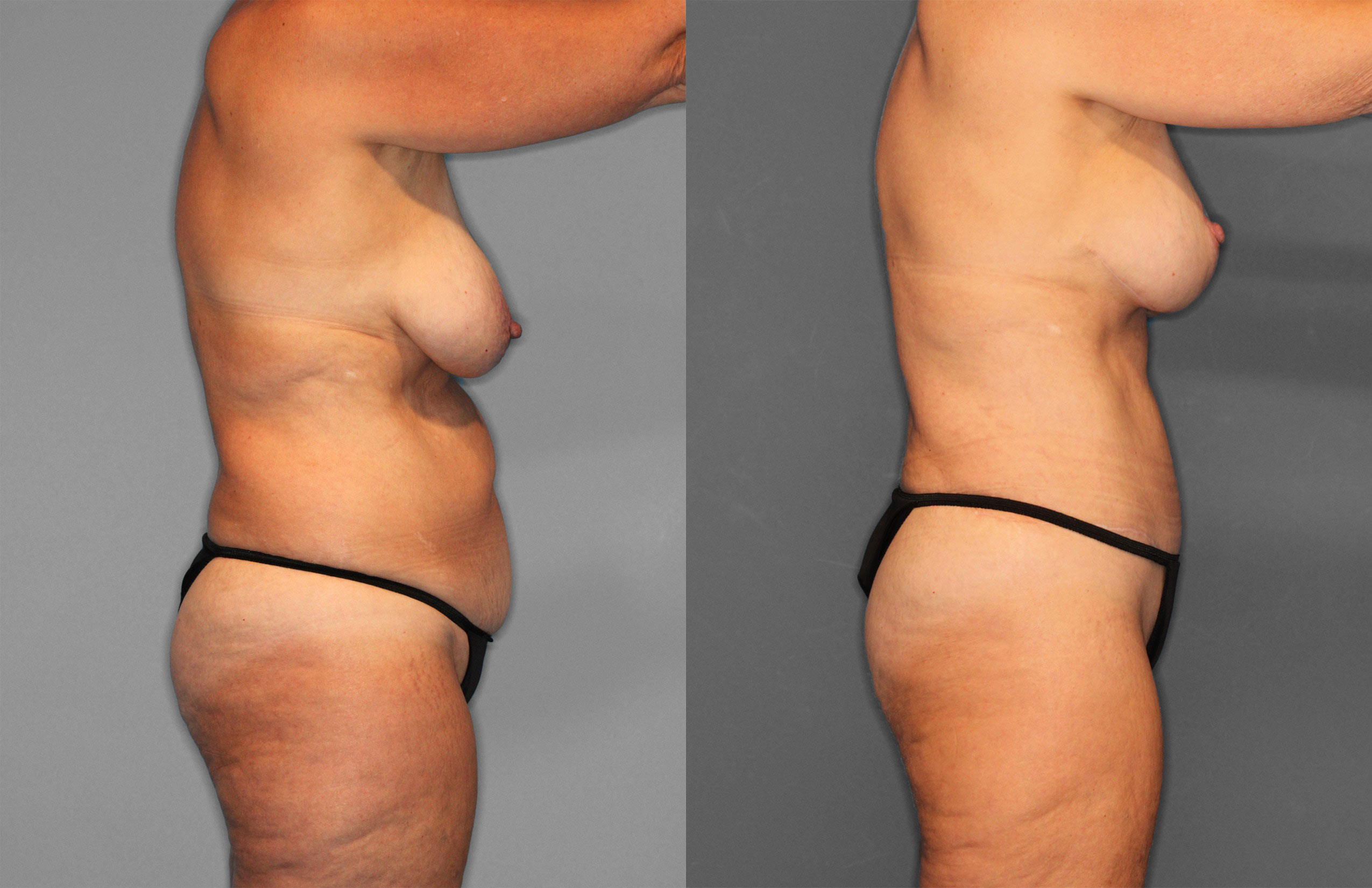 Tummy Tuck Before and After photo by Dr. Abigail Rodriguez in Houston, TX