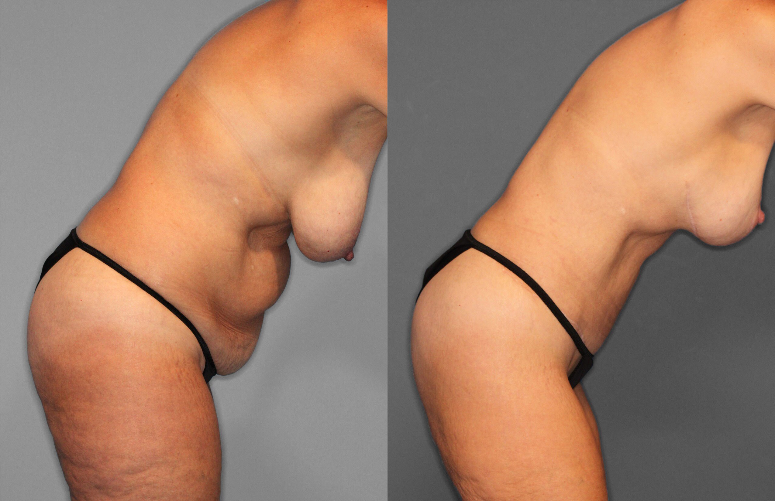 Tummy Tuck Before and After photo by Dr. Abigail Rodriguez in Houston, TX