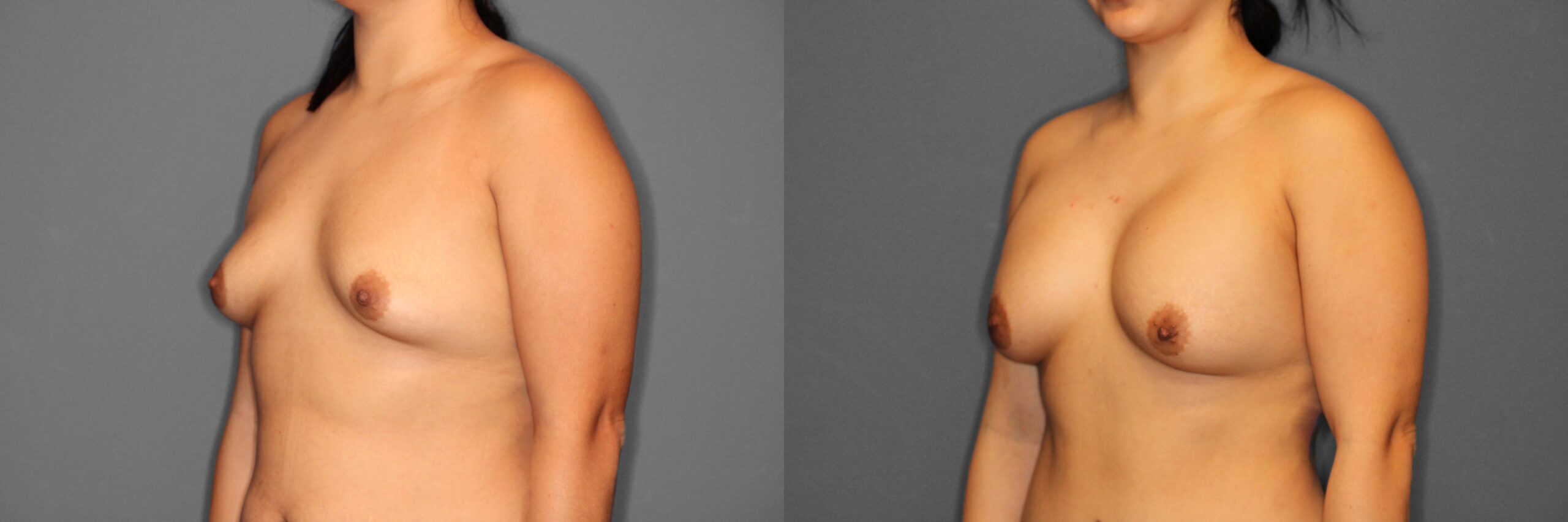 Breast Augmentation Before and After photo by Dr. Abigail Rodriguez in Houston, TX