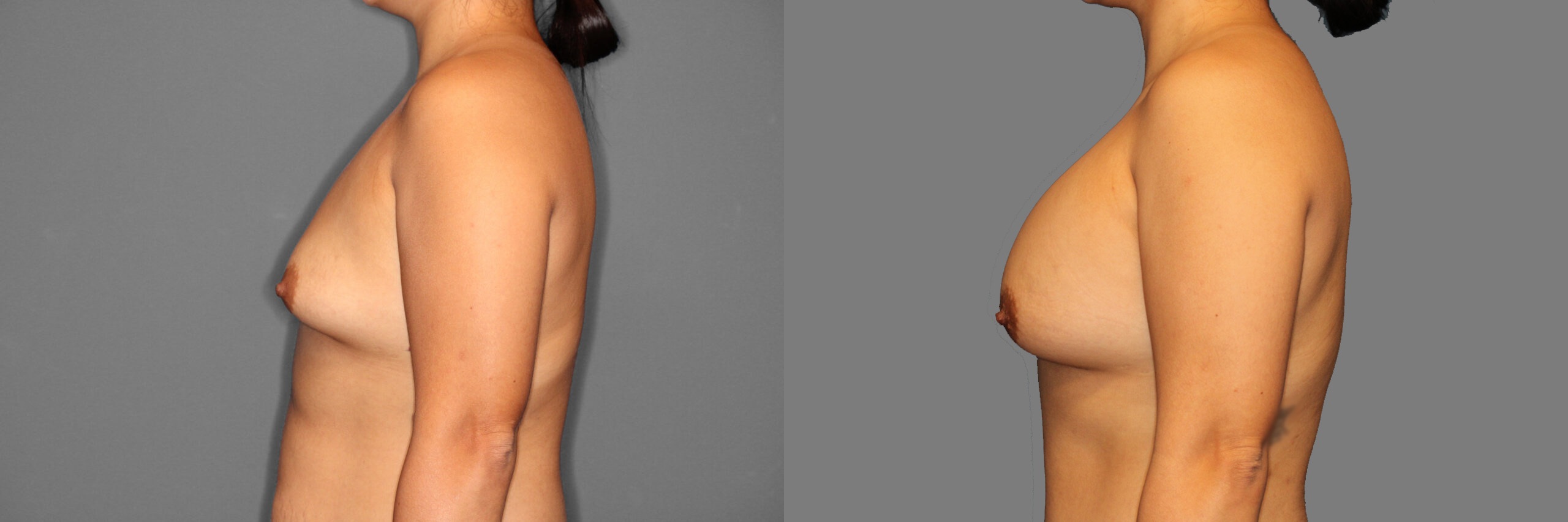 Breast Augmentation Before and After photo by Dr. Abigail Rodriguez in Houston TX