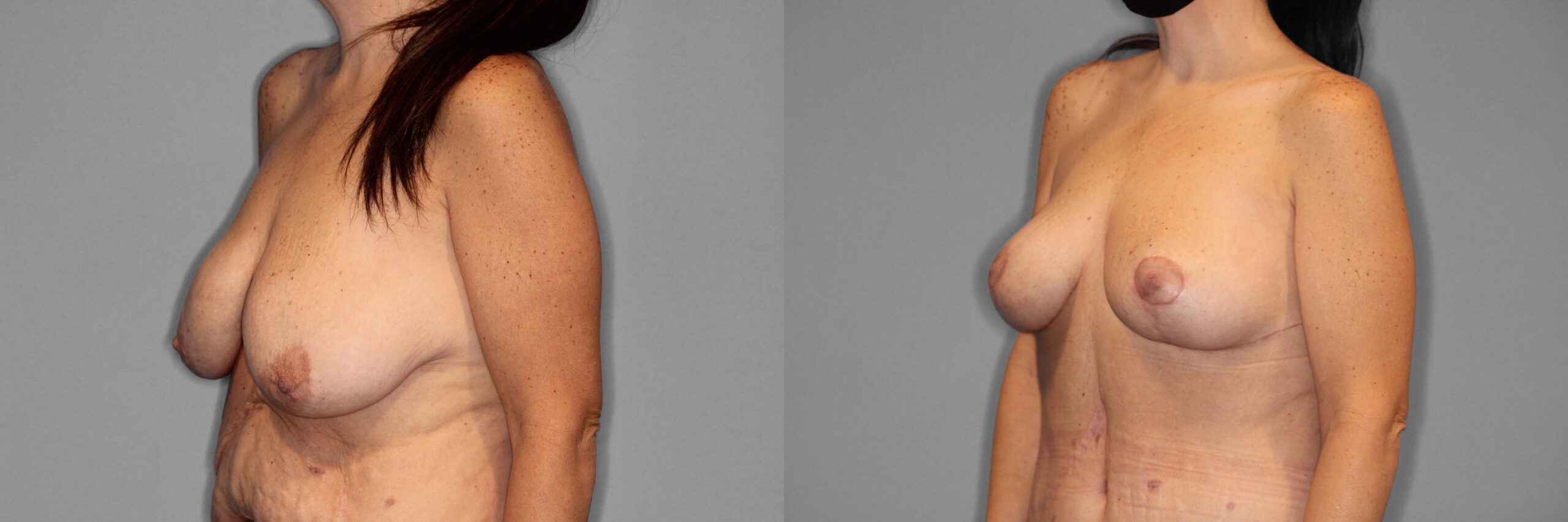 Breast Lift Before and After photo by Dr. Abigail Rodriguez in Houston, TX
