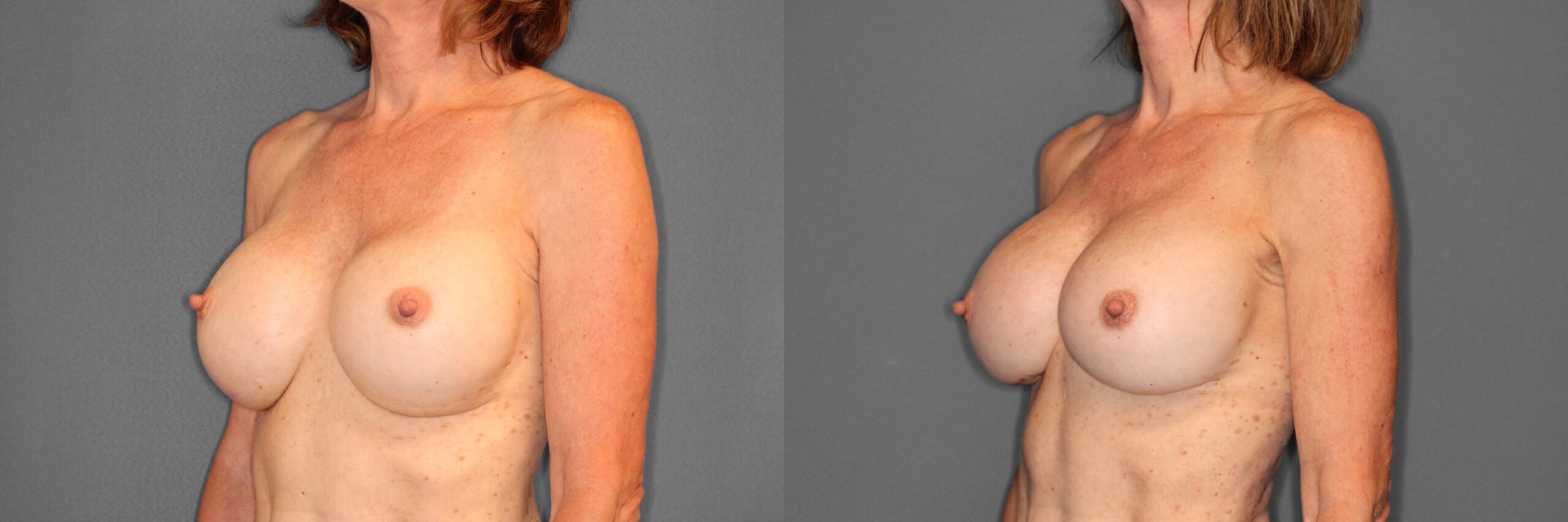 Breast Revision Before and After photo by Dr. Abigail Rodriguez in Houston, TX