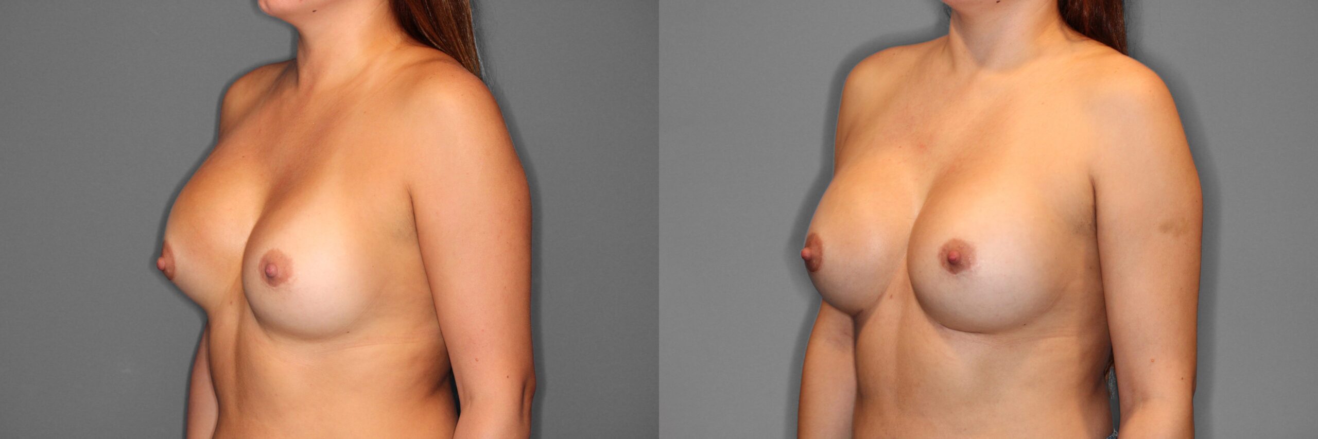 Breast Revision Before and After photo by Dr. Abigail Rodriguez in Houston, TX