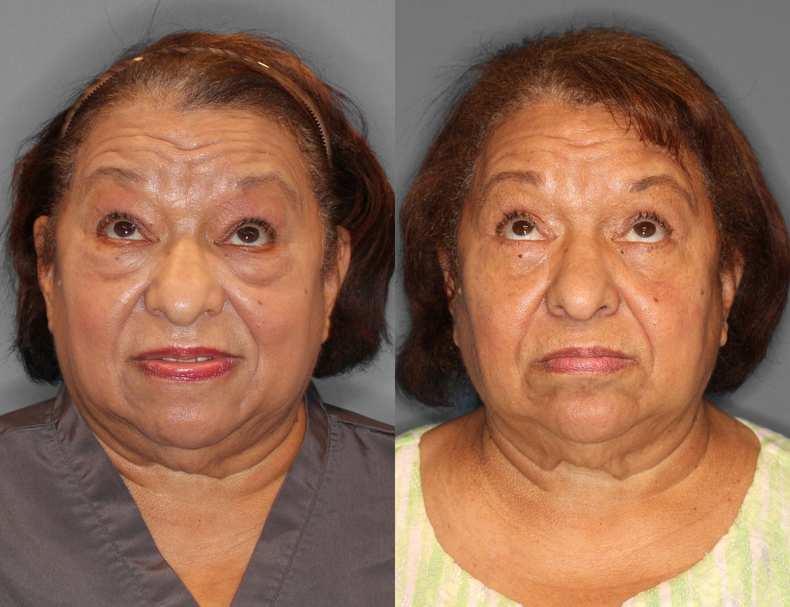 Eyelid Lift Before and After photo by Dr. Abigail Rodriguez in Houston, TX