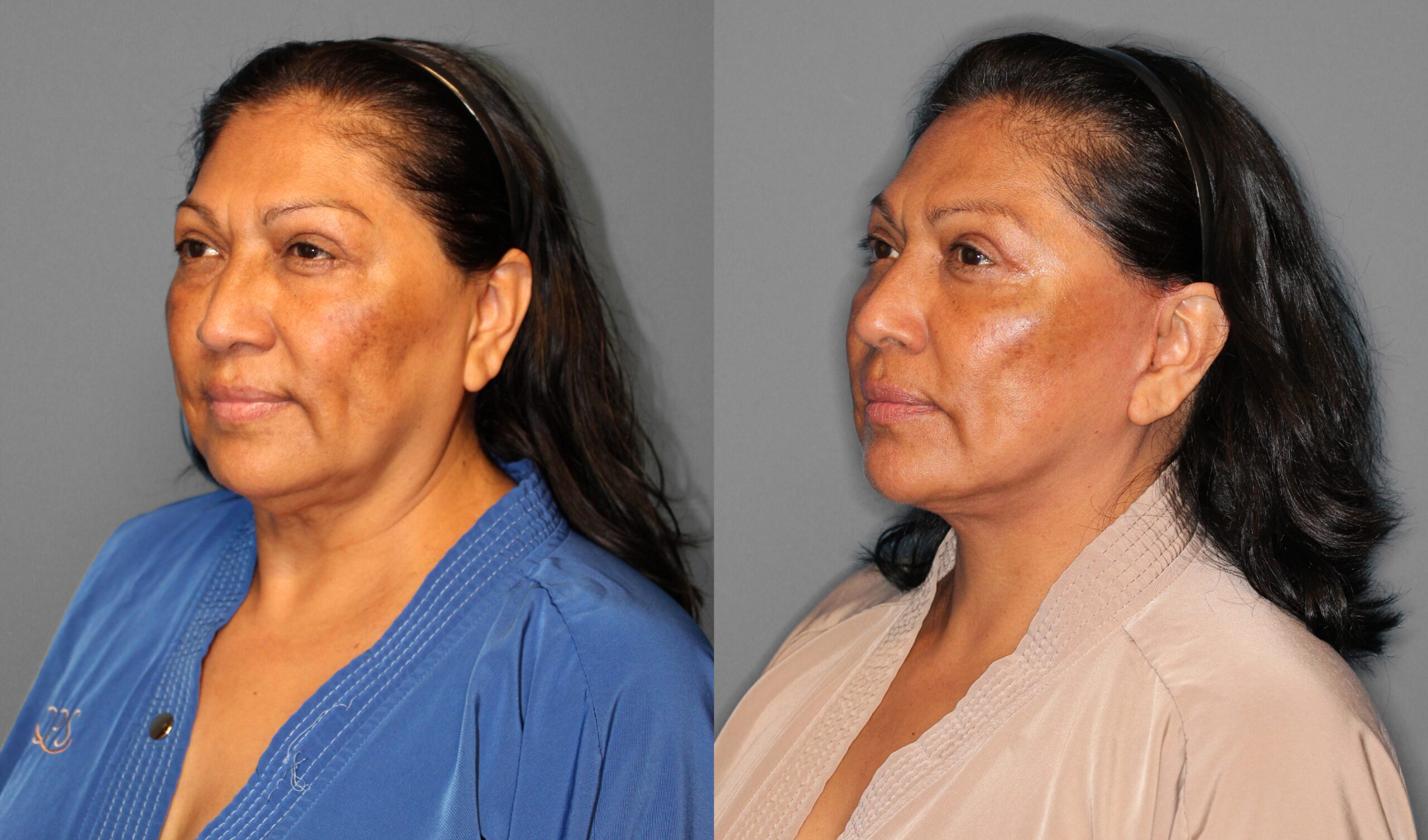 Face & Neck Lift, Eyelid Lift Before and After photo by Dr. Abigail Rodriguez in Houston, TX