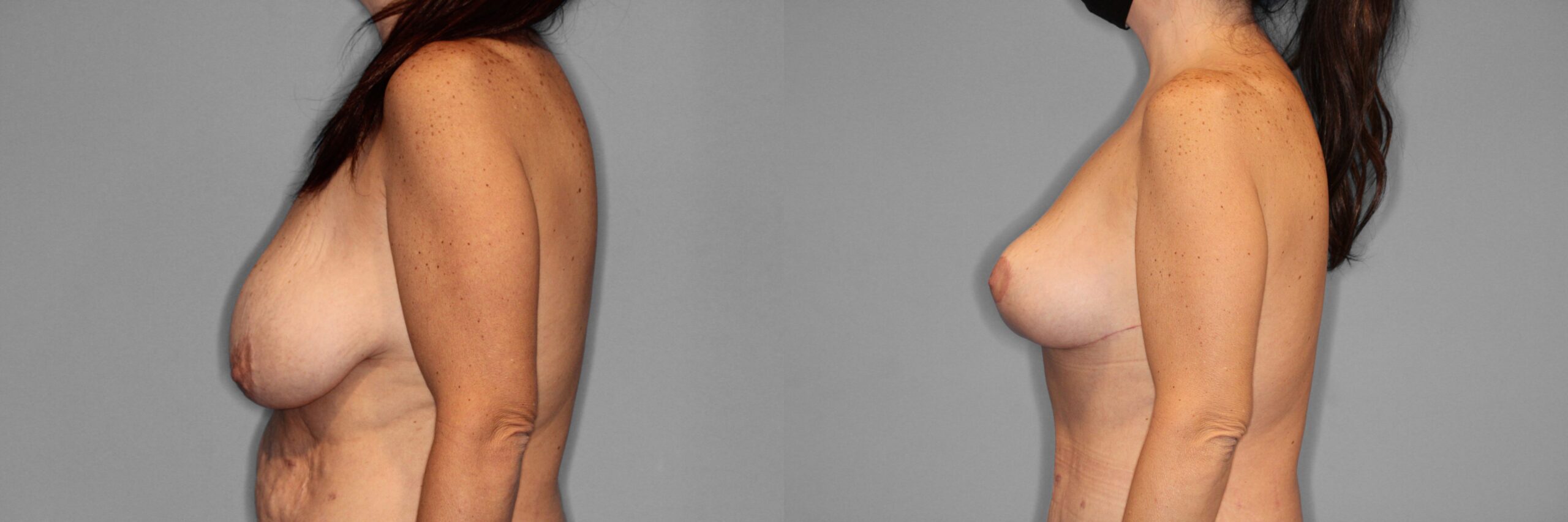 Breast Lift Before and After photo by Dr. Abigail Rodriguez in Houston, TX