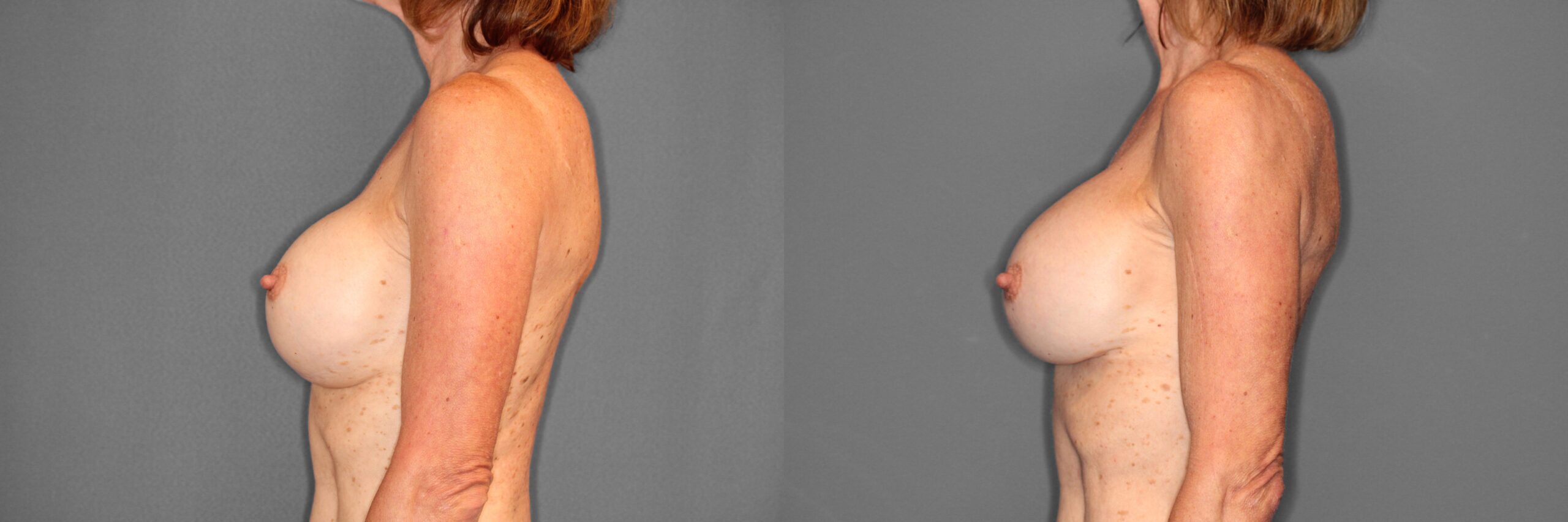 Breast Revision Before and After photo by Dr. Abigail Rodriguez in Houston, TX