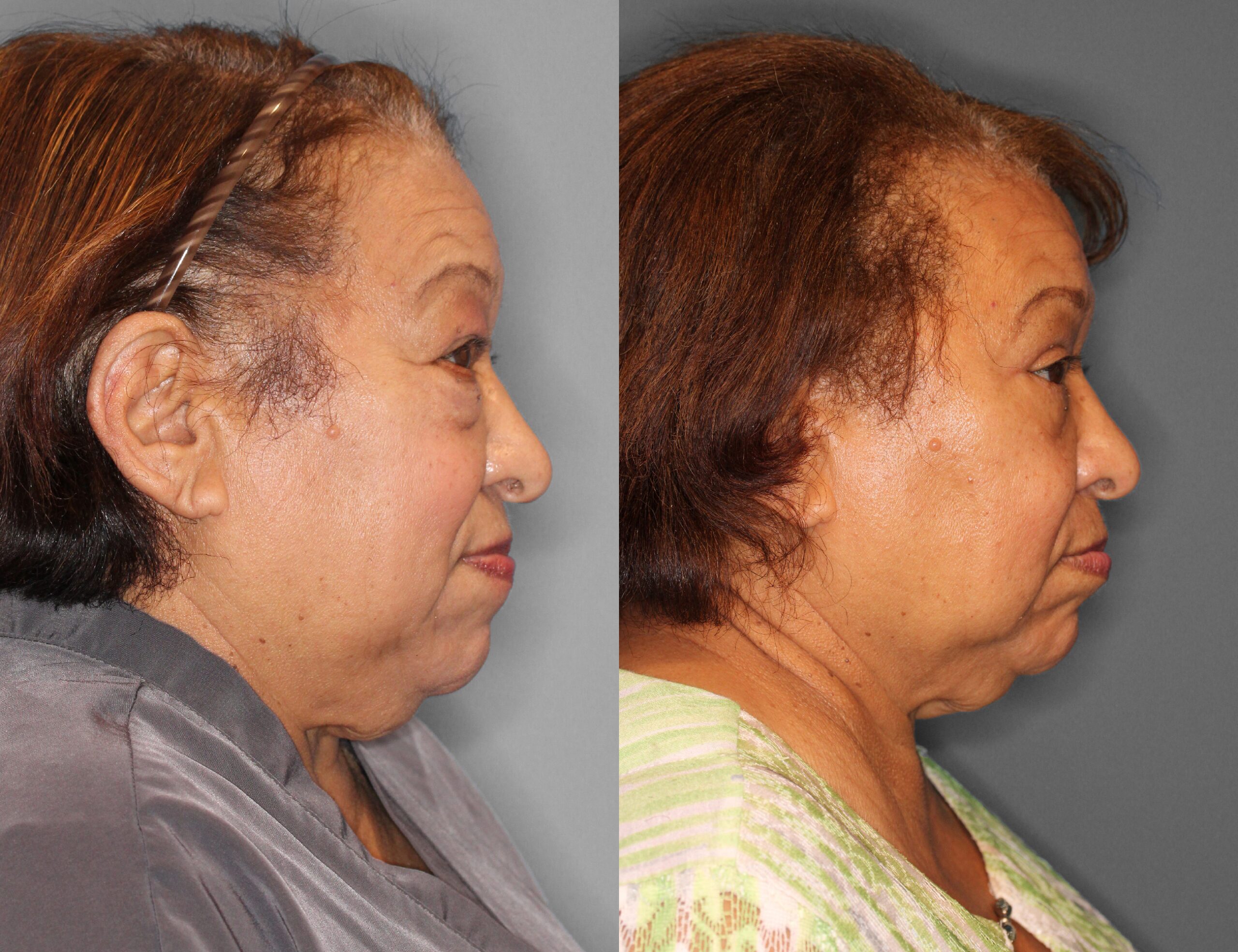 Eyelid Lift Before and After photo by Dr. Abigail Rodriguez in Houston, TX