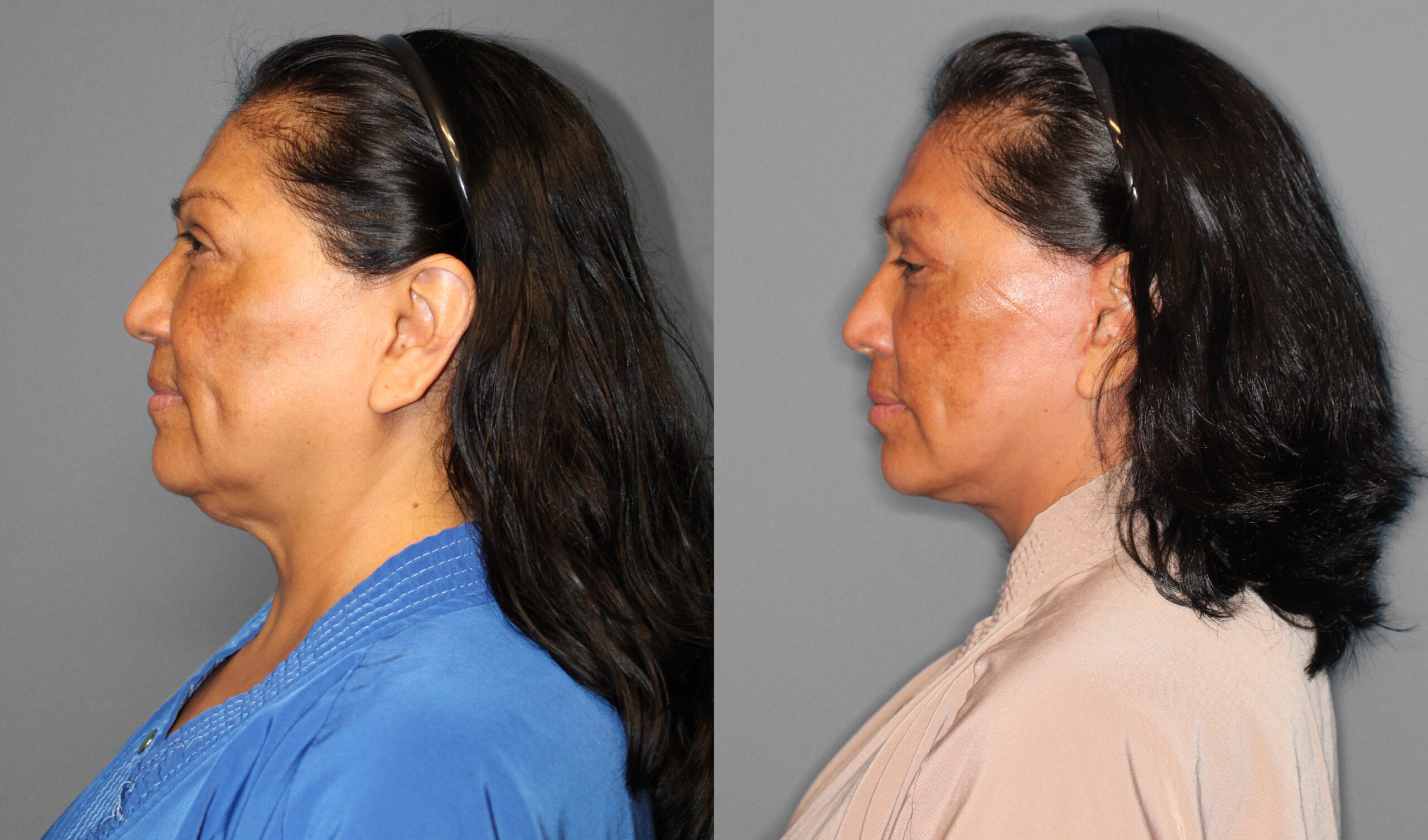 Face & Neck Lift, Eyelid Lift Before and After photo by Dr. Abigail Rodriguez in Houston, TX
