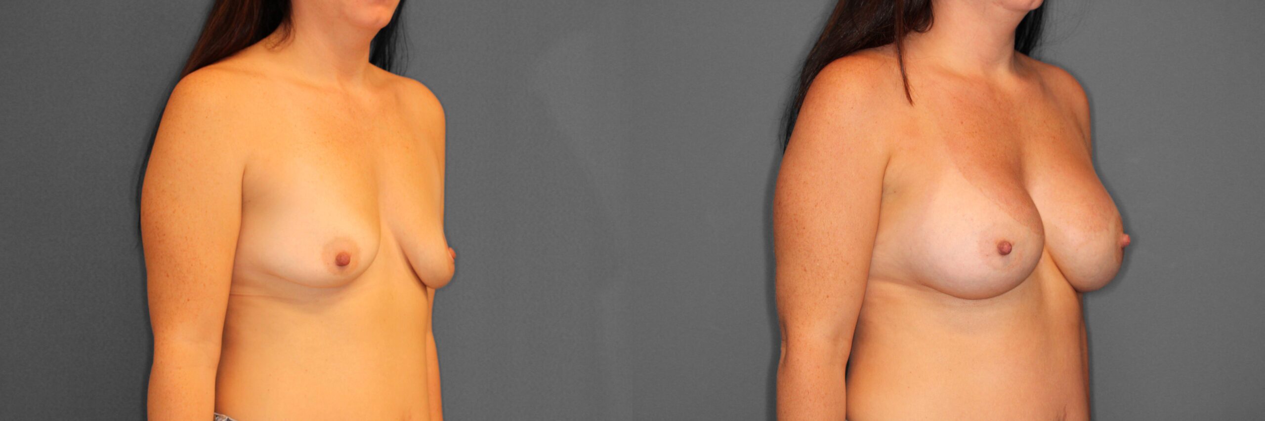 Breast Augmentation Before and After photo by Dr. Abigail Rodriguez in Houston, TX
