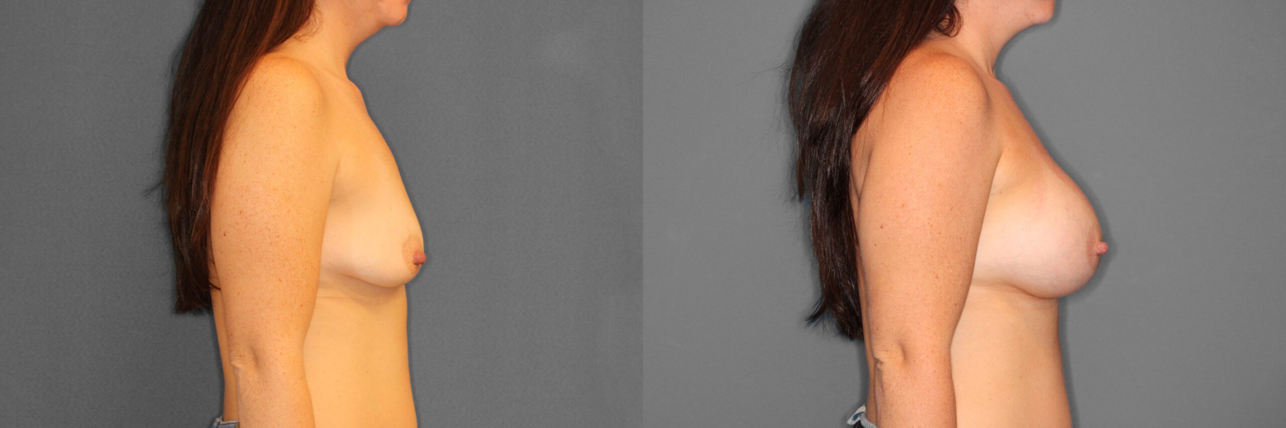 Breast Augmentation Before and After photo by Dr. Abigail Rodriguez in Houston, TX