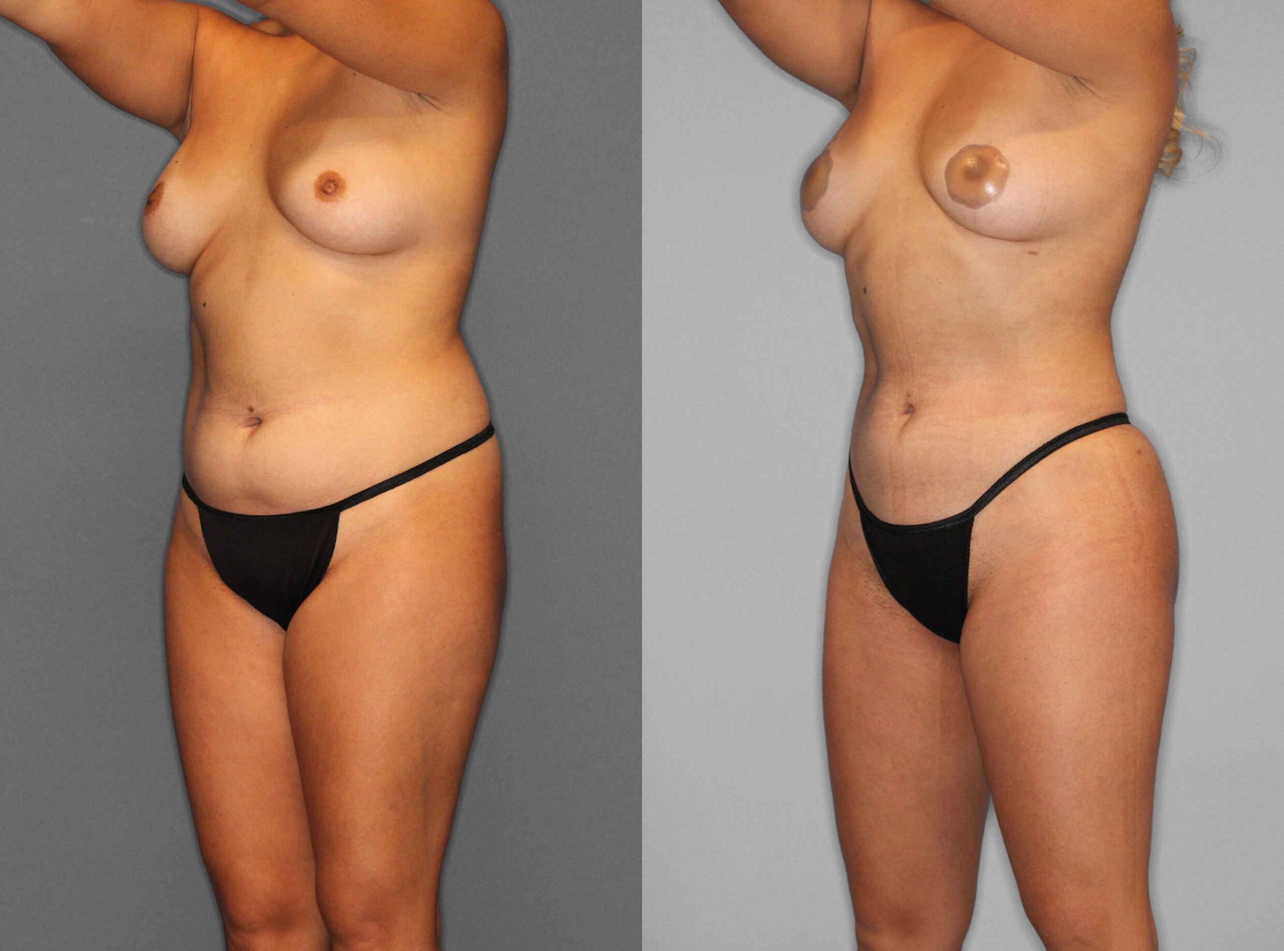 Fat Grafting:Liposuction Before and After photo by Dr. Abigail Rodriguez in Houston, TX