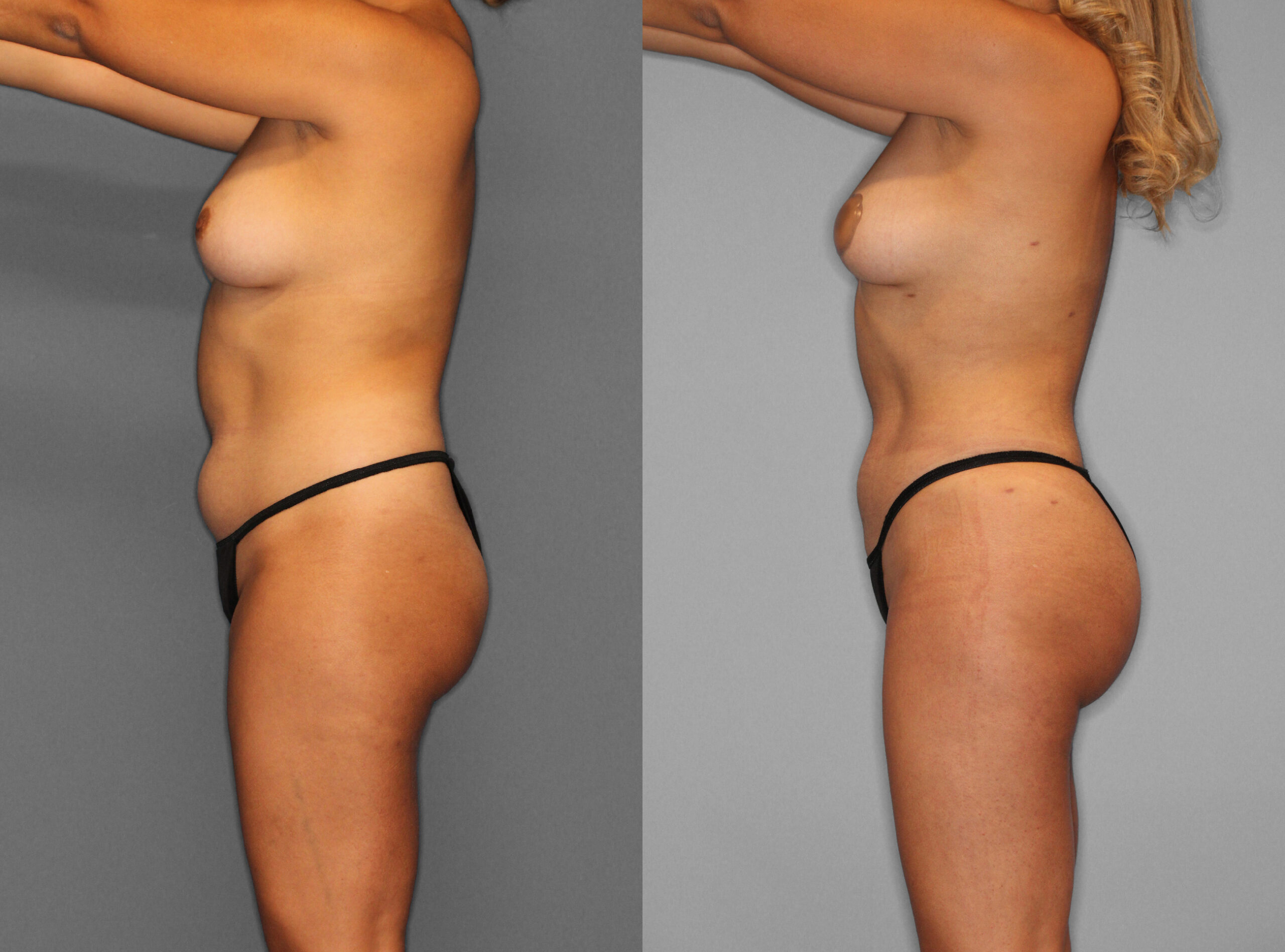 Fat Grafting:Liposuction Before and After photo by Dr. Abigail Rodriguez in Houston, TX