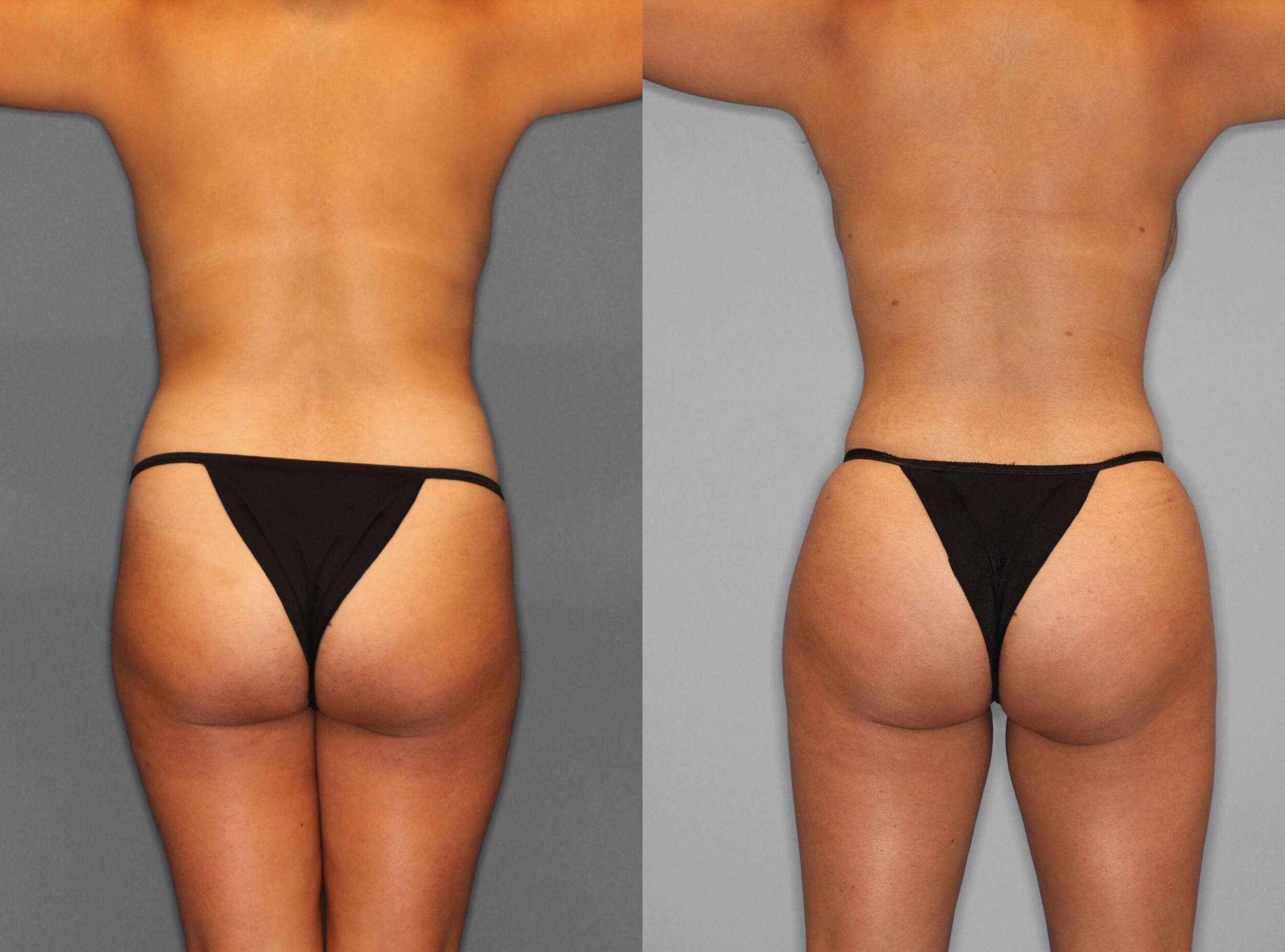 Fat Grafting:Liposuction Before and After photo by Dr. Abigail Rodriguez in Houston, TX