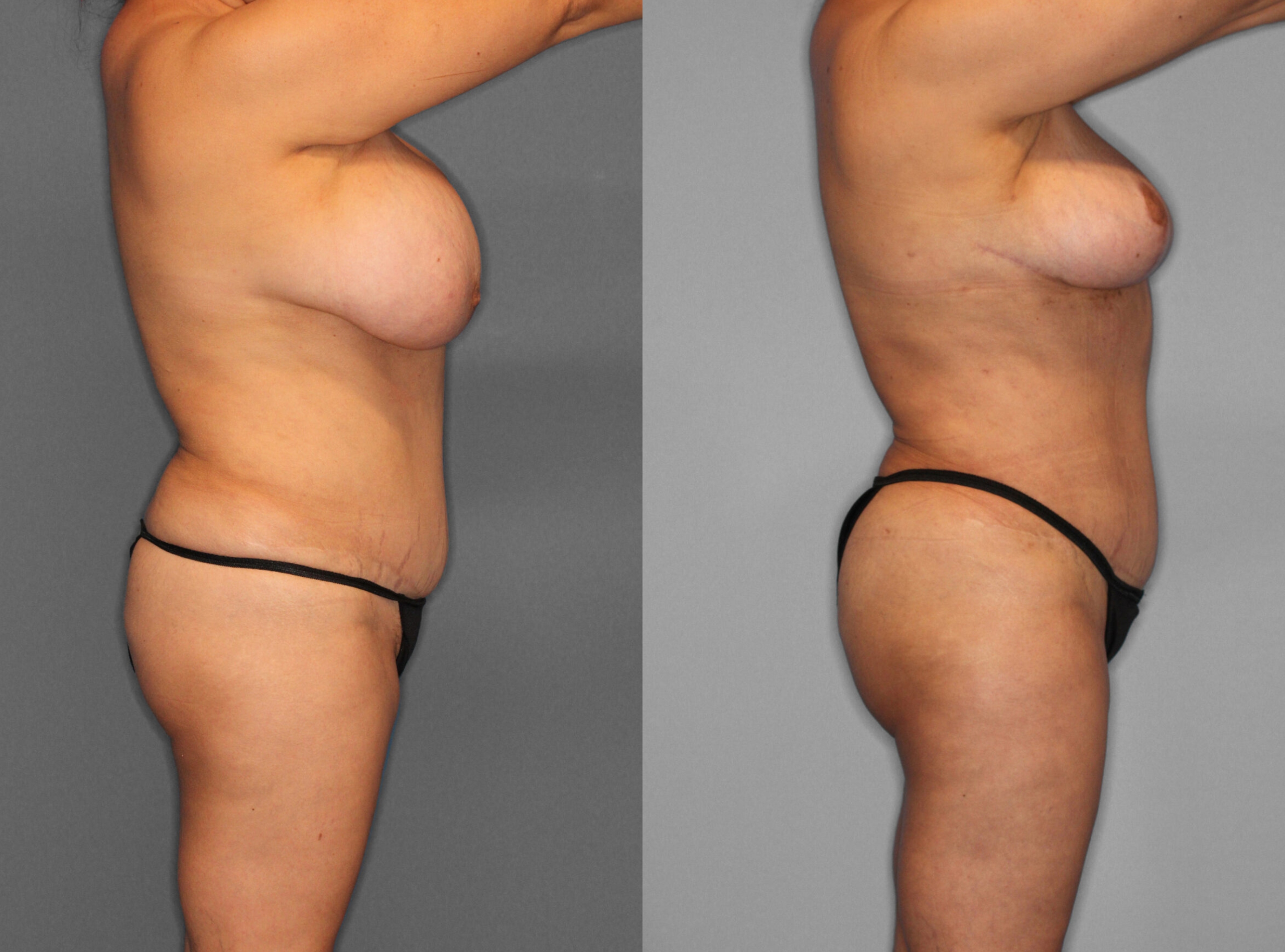Fat Grafting:Liposuction Before and After photo by Dr. Abigail Rodriguez in Houston, TX