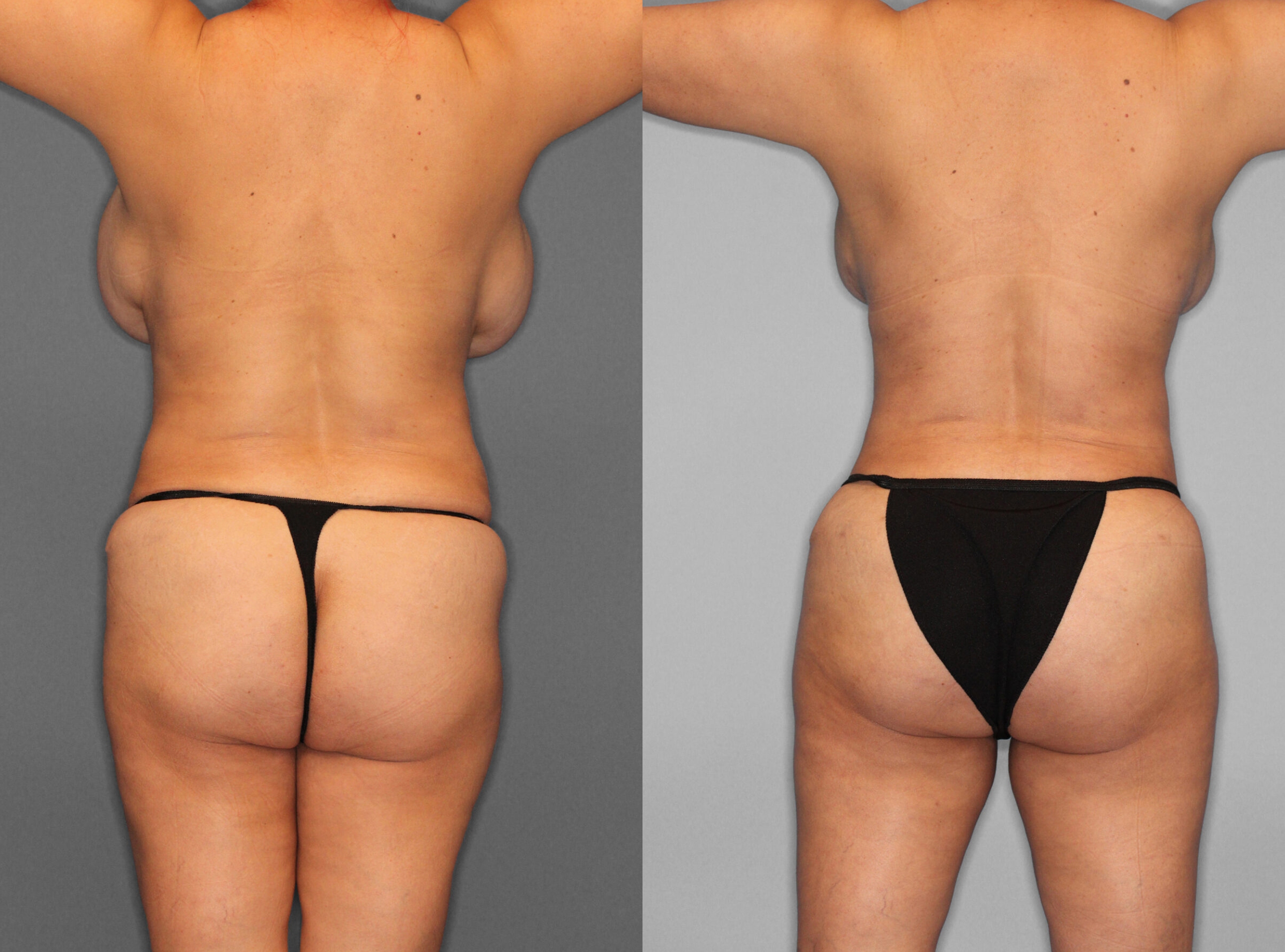 Fat Grafting:Liposuction Before and After photo by Dr. Abigail Rodriguez in Houston, TX