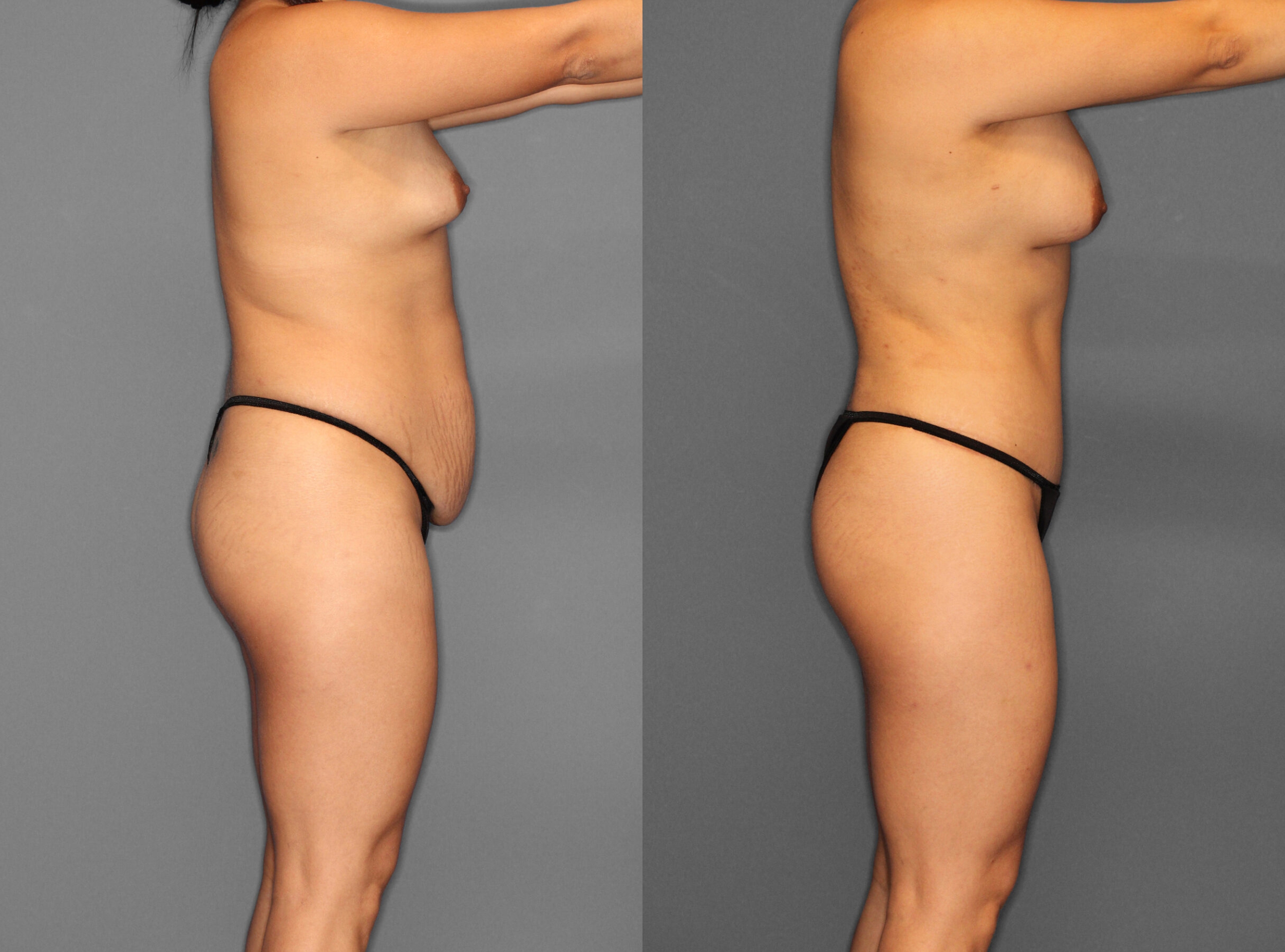 Liposuction:Tummy Tuck Before and After photo by Dr. Abigail Rodriguez in Houston, TX