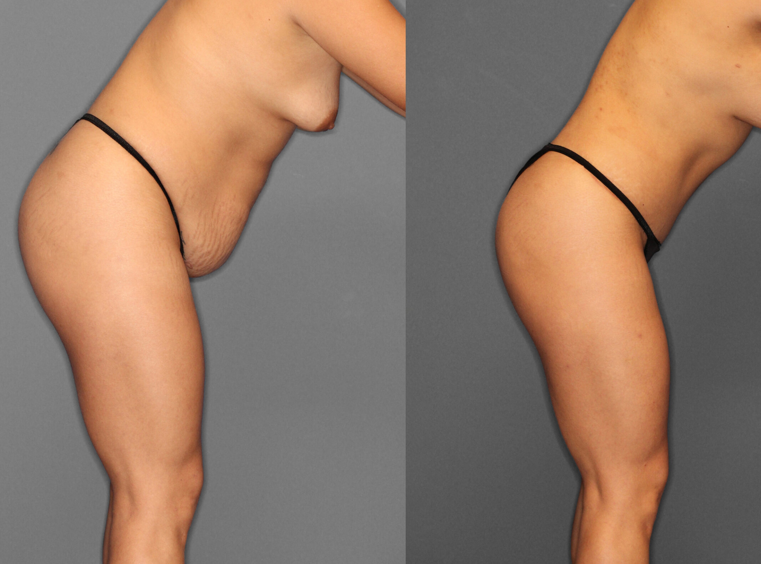 Liposuction:Tummy Tuck Before and After photo by Dr. Abigail Rodriguez in Houston, TX