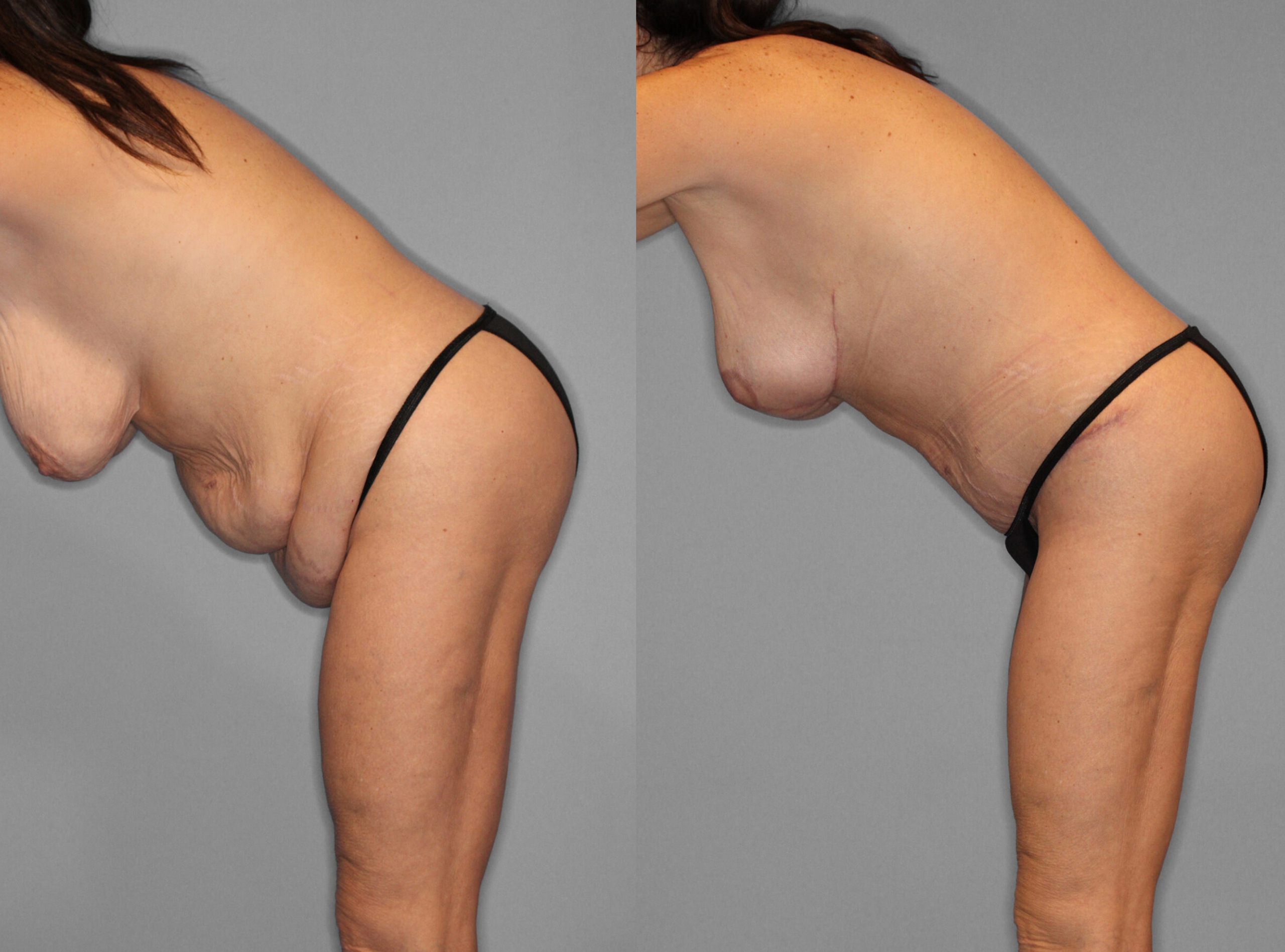 Liposuction:Tummy Tuck Before and After photo by Dr. Abigail Rodriguez in Houston, TX