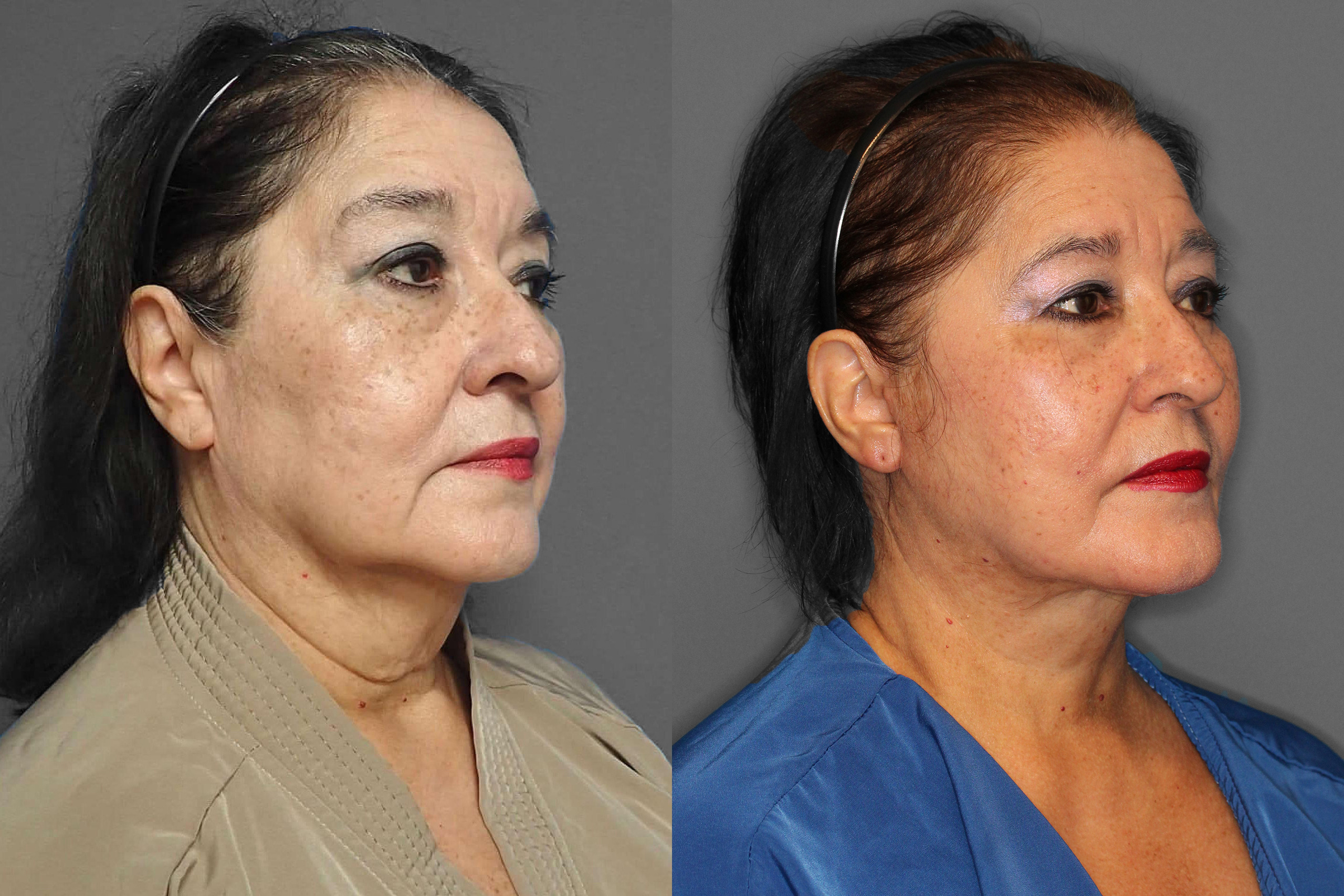 Face/Neck Lift + Lower Blepharoplasty Before and After photo by Dr. Abigail Rodriguez in Houston, TX