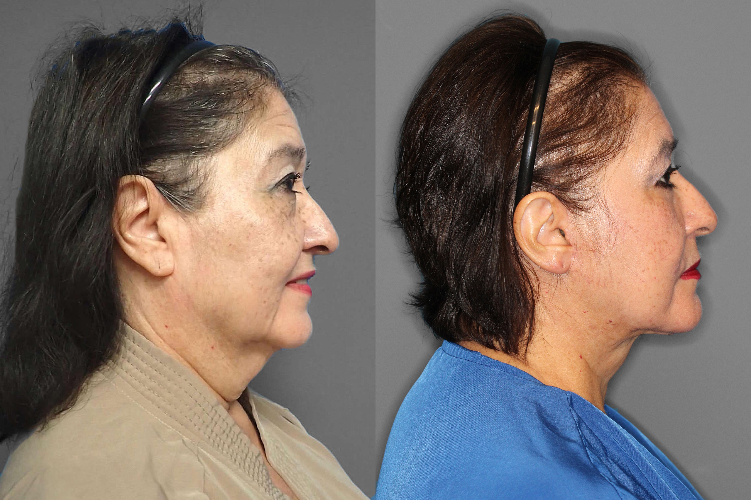 Face/Neck Lift + Lower Blepharoplasty Before and After photo by Dr. Abigail Rodriguez in Houston, TX