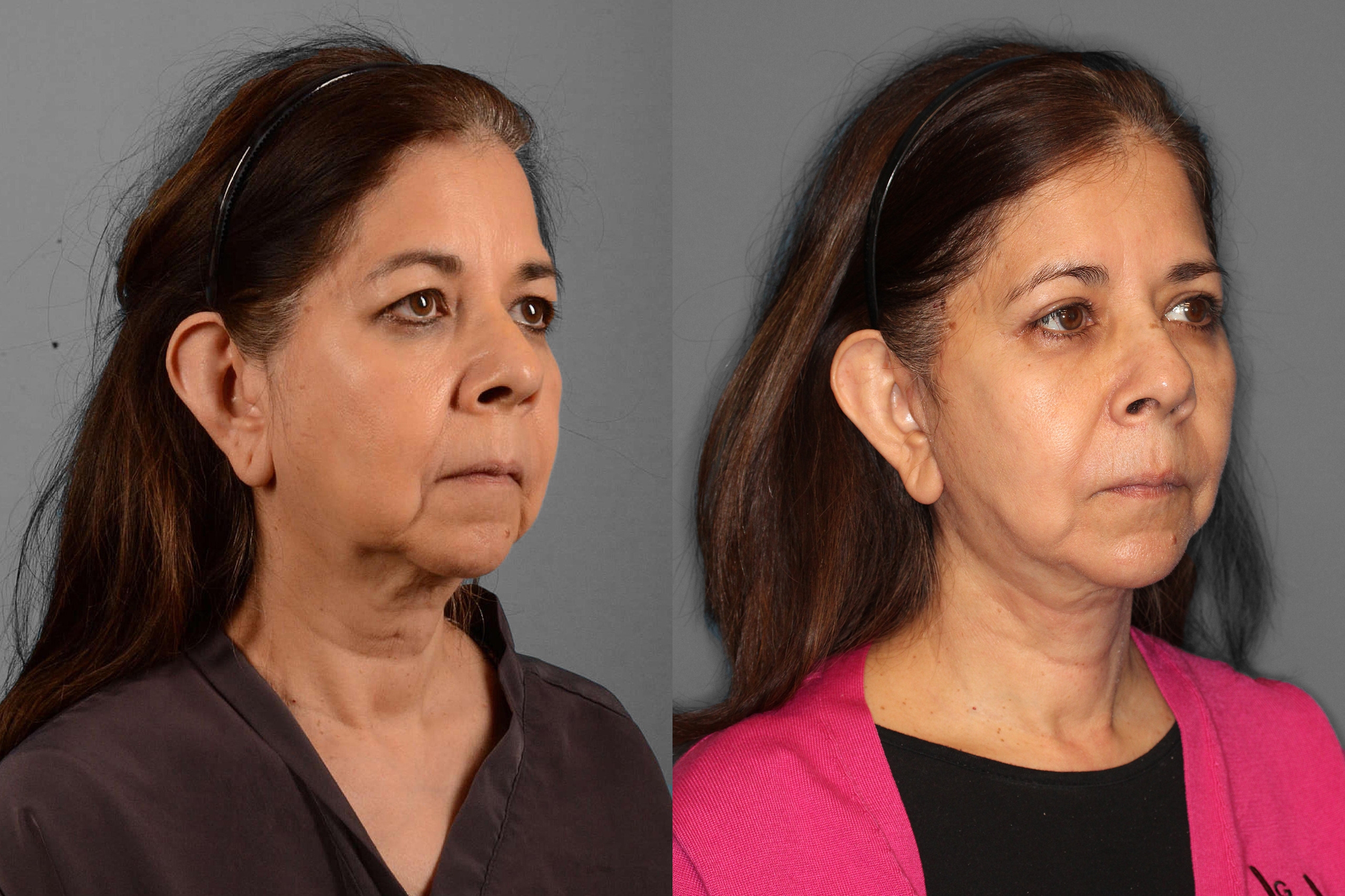 Face/Neck Lift + Buccal Fat + Upper Blepharoplasty Before and After photo by Dr. Abigail Rodriguez in Houston, TX