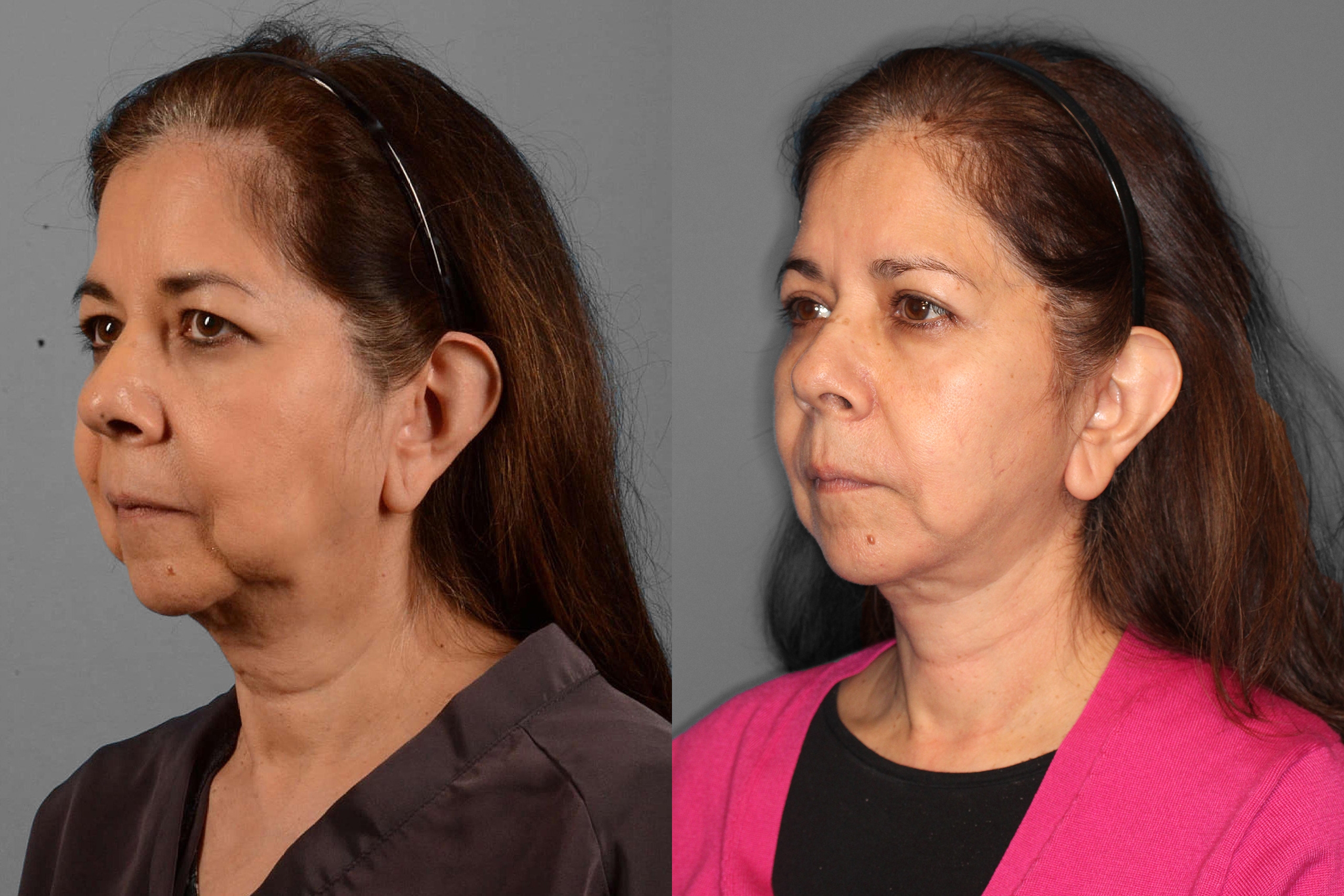 Face/Neck Lift + Buccal Fat + Upper Blepharoplasty Before and After photo by Dr. Abigail Rodriguez in Houston, TX