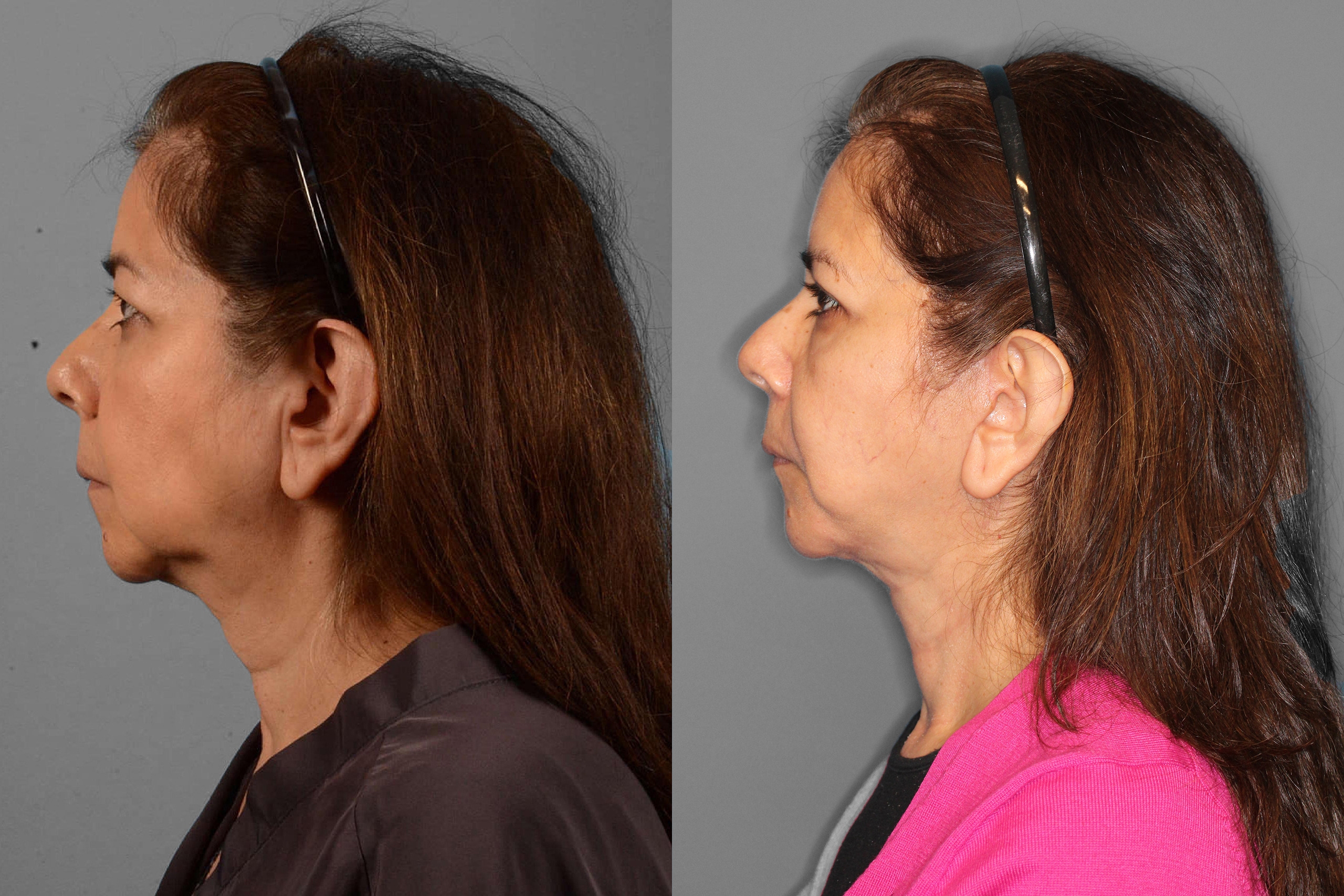 Face/Neck Lift + Buccal Fat + Upper Blepharoplasty Before and After photo by Dr. Abigail Rodriguez in Houston, TX