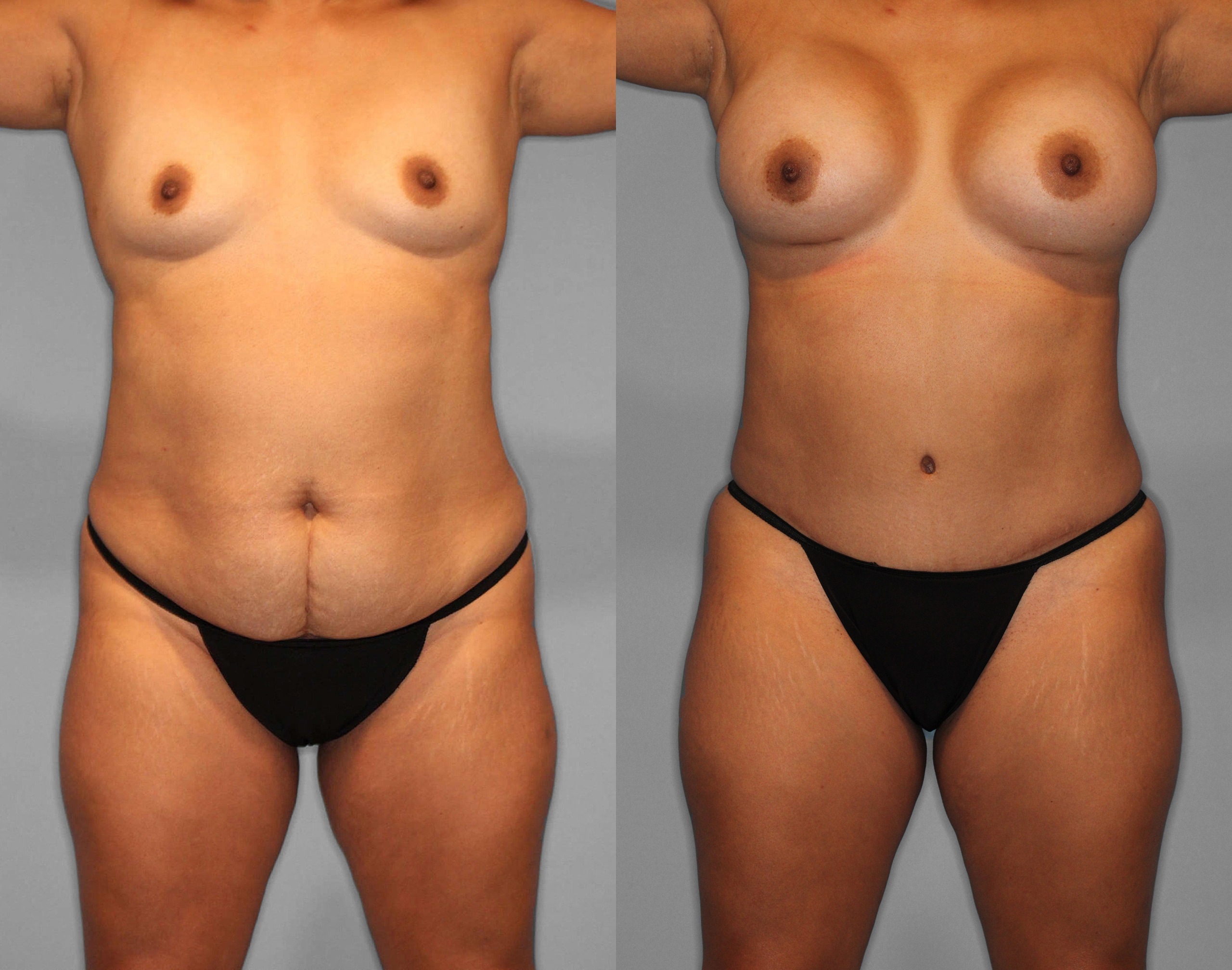 Tummy Tuck + Liposuction Before and After photo by Dr. Abigail Rodriguez in Houston, TX