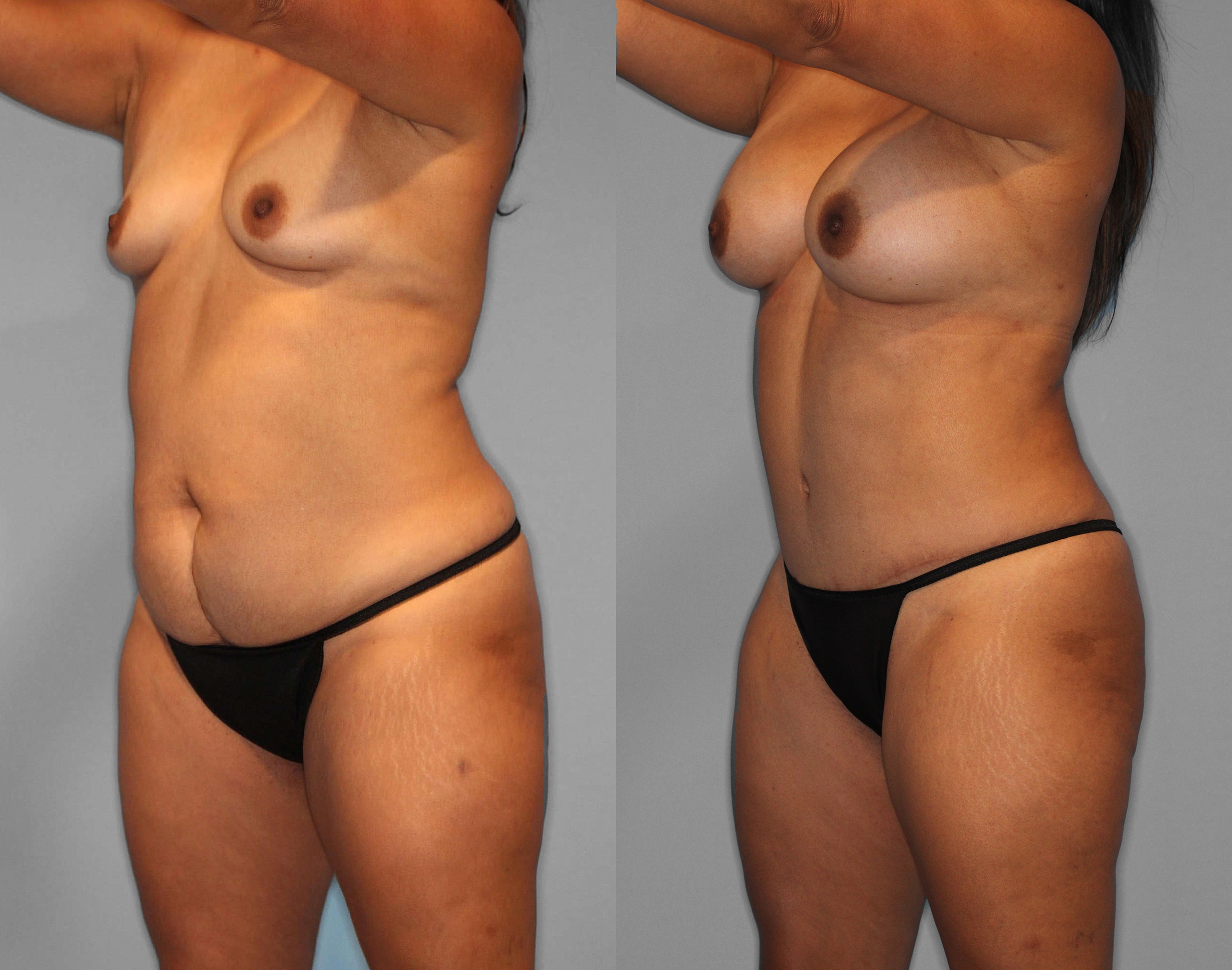 Tummy Tuck + Liposuction Before and After photo by Dr. Abigail Rodriguez in Houston, TX