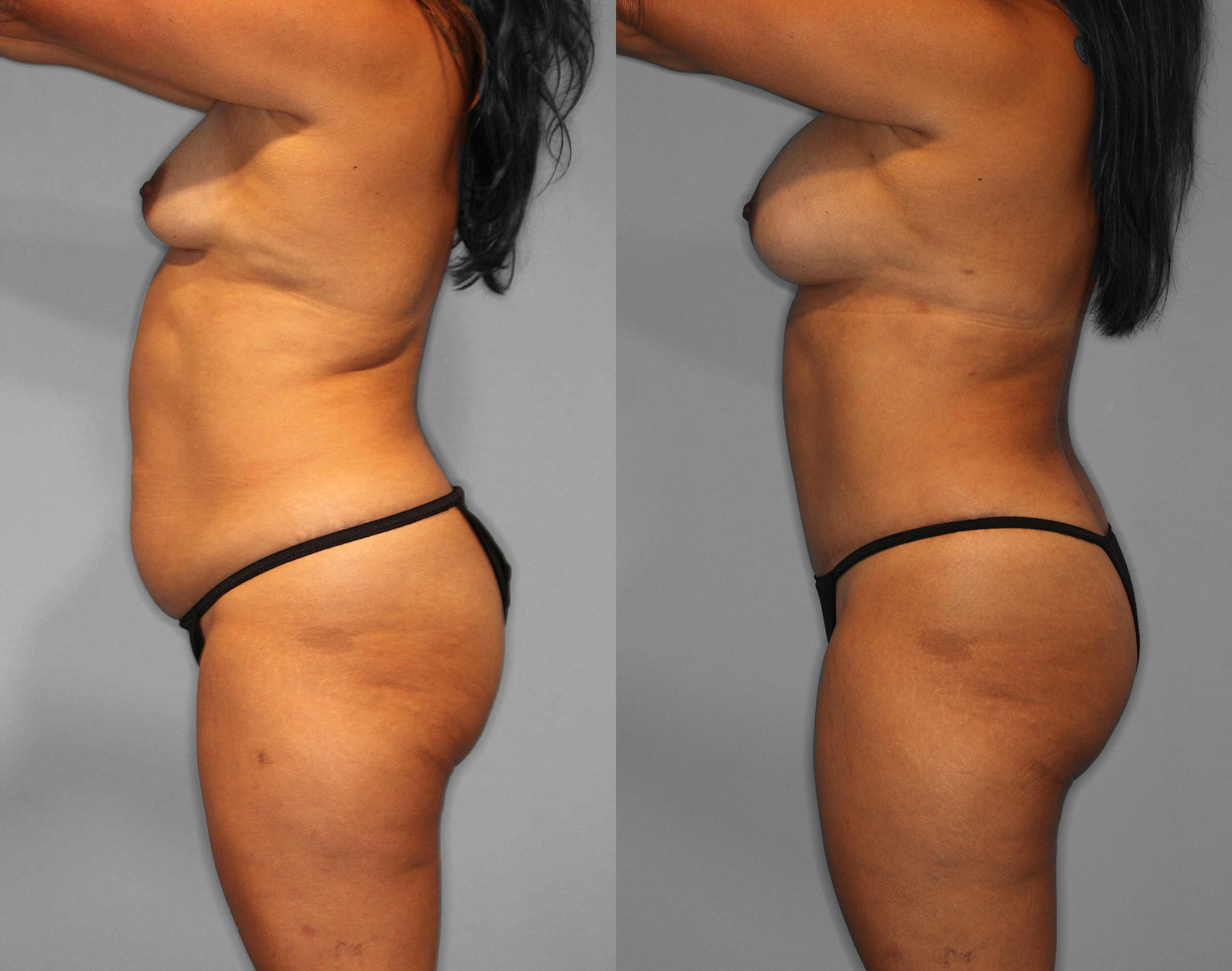 Tummy Tuck + Liposuction Before and After photo by Dr. Abigail Rodriguez in Houston, TX
