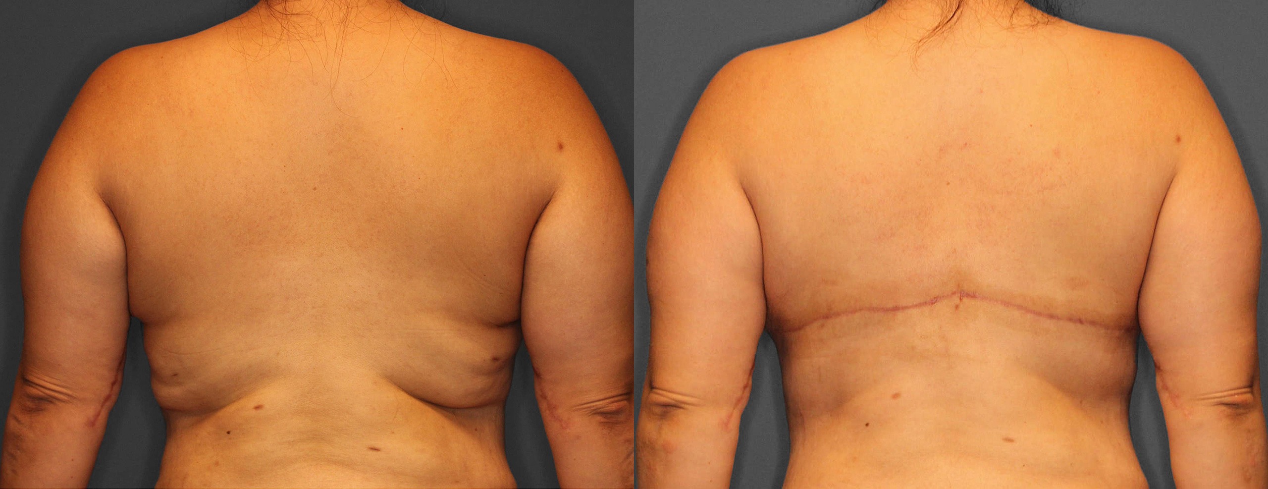 Bra Line Lift Before and After photo by Dr. Abigail Rodriguez in Houston, TX