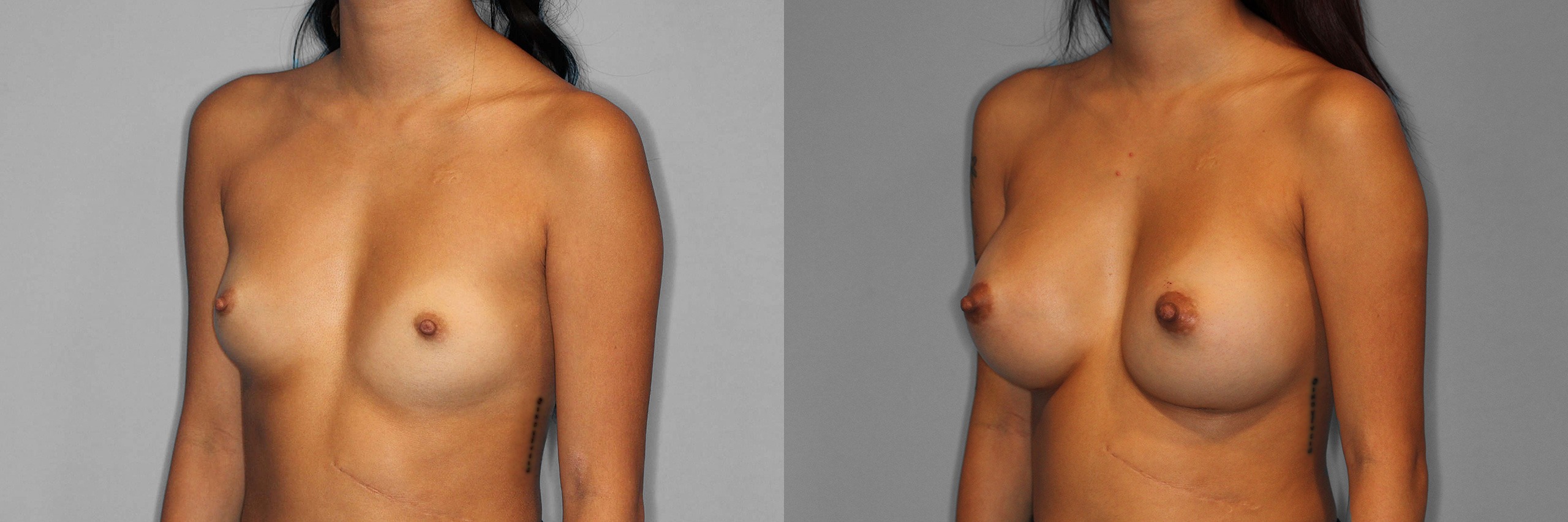 Breast Augmentation Before and After photo by Dr. Abigail Rodriguez in Houston, TX