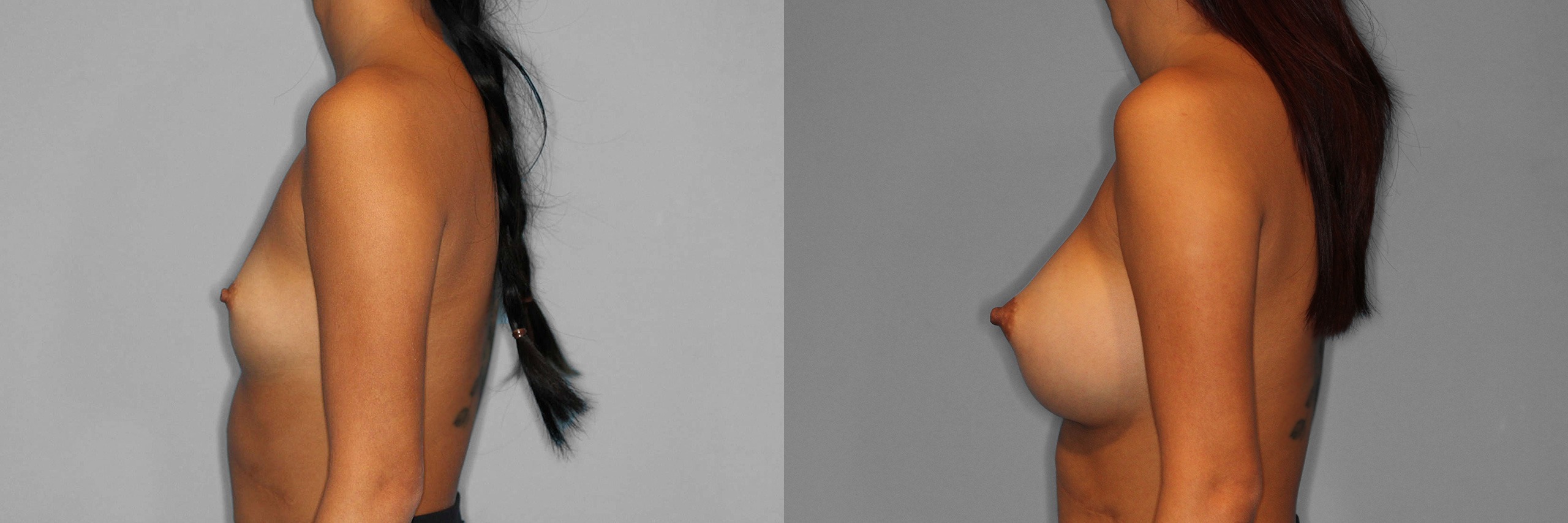 Breast Augmentation Before and After photo by Dr. Abigail Rodriguez in Houston, TX