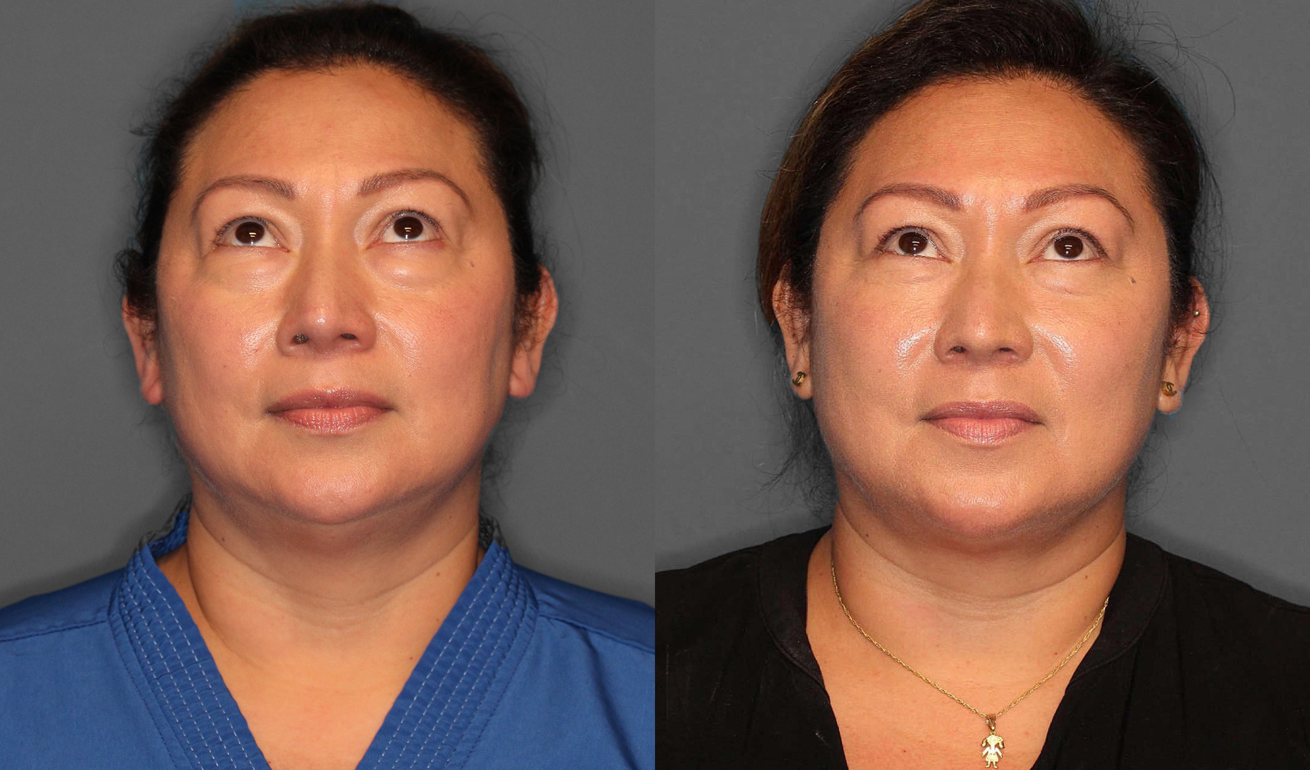 Lower Blepharoplasty Before and After photo by Dr. Abigail Rodriguez in Houston, TX